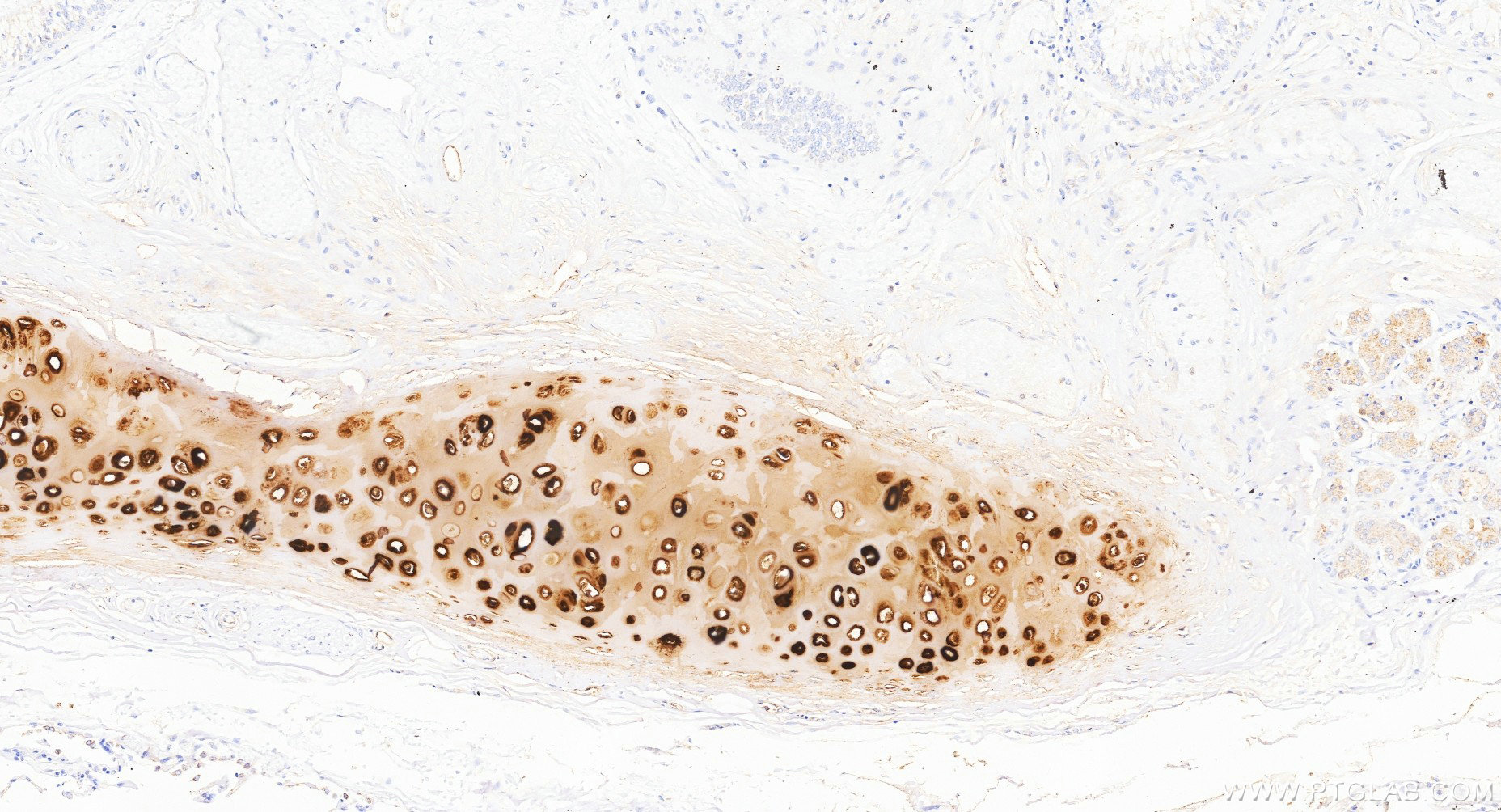 IHC staining of human lung cancer using Biotin-84819-5 Immunohistochemistry (IHC) staining of human lung cancer tissue using Biotin-conjugated Aggrecan Recombinant monoclonal (Biotin-84819-5)