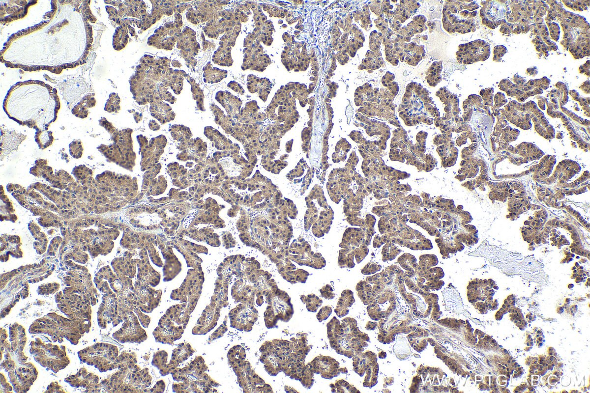 Immunohistochemistry (IHC) staining of human thyroid cancer tissue using Ajuba Polyclonal antibody (28686-1-AP)