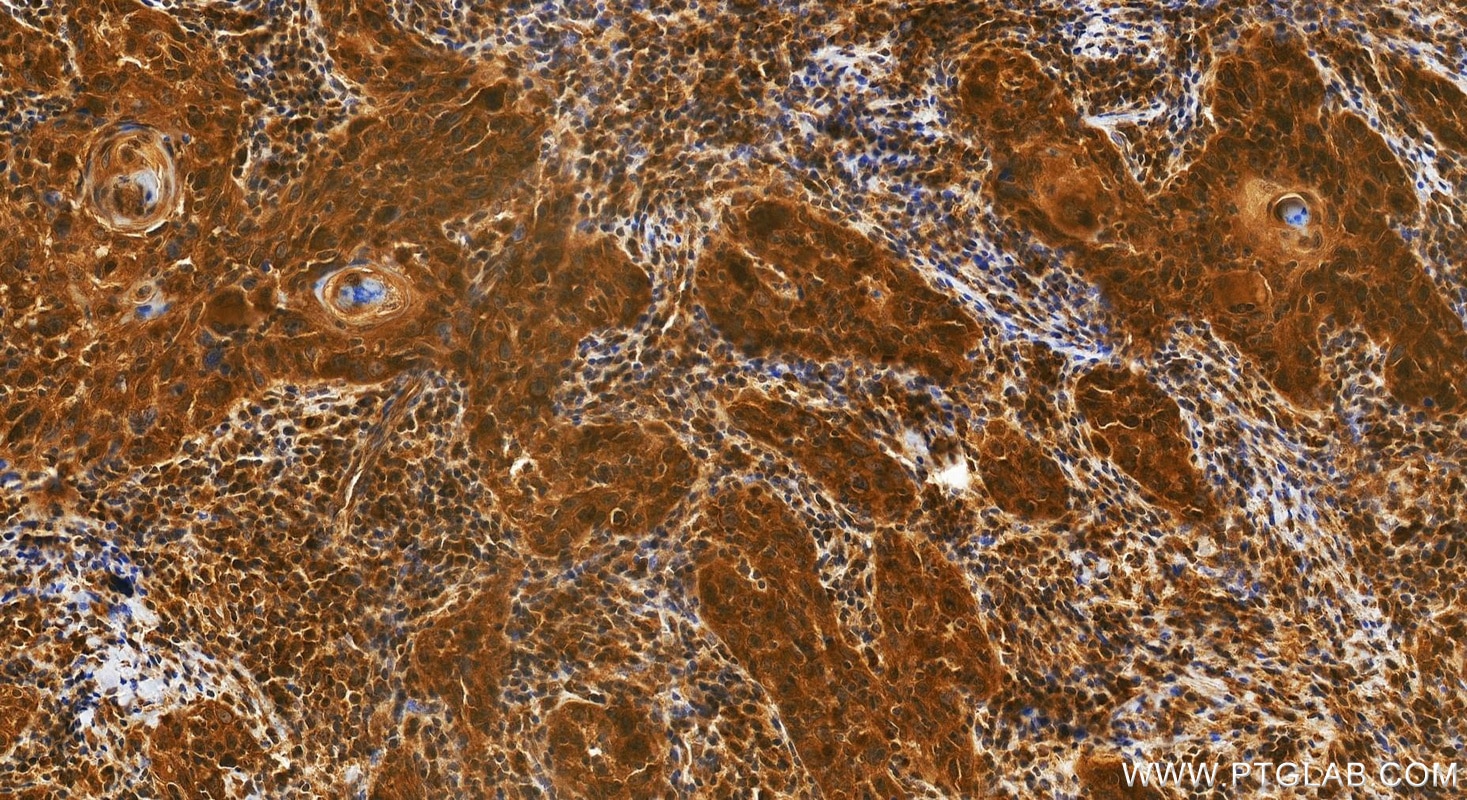 IHC staining of human skin cancer using 28686-1-AP Immunohistochemistry (IHC) staining of human skin cancer tissue using Ajuba Polyclonal antibody (28686-1-AP)