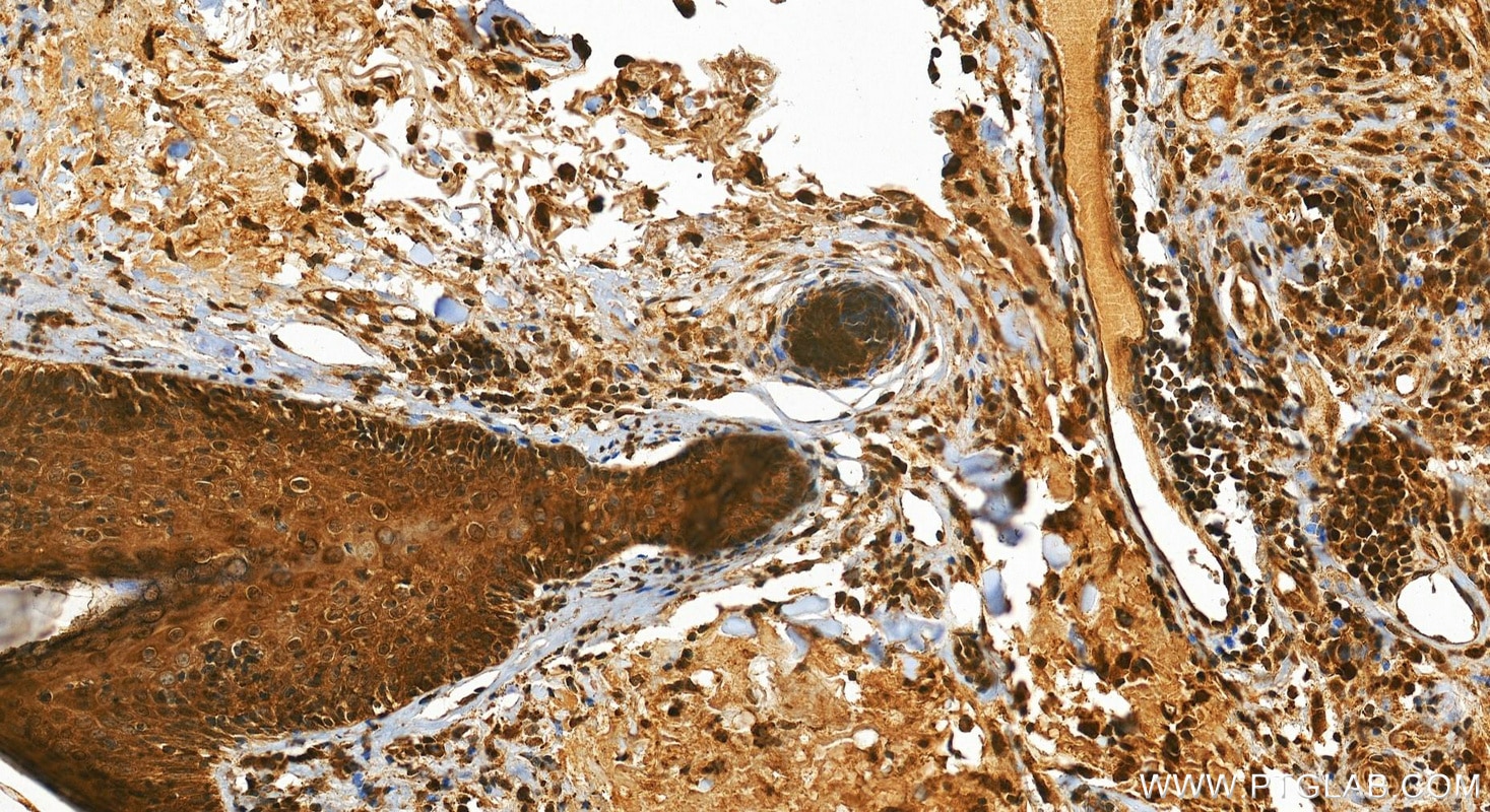 IHC staining of human skin cancer using 28686-1-AP Immunohistochemistry (IHC) staining of human skin cancer tissue using Ajuba Polyclonal antibody (28686-1-AP)