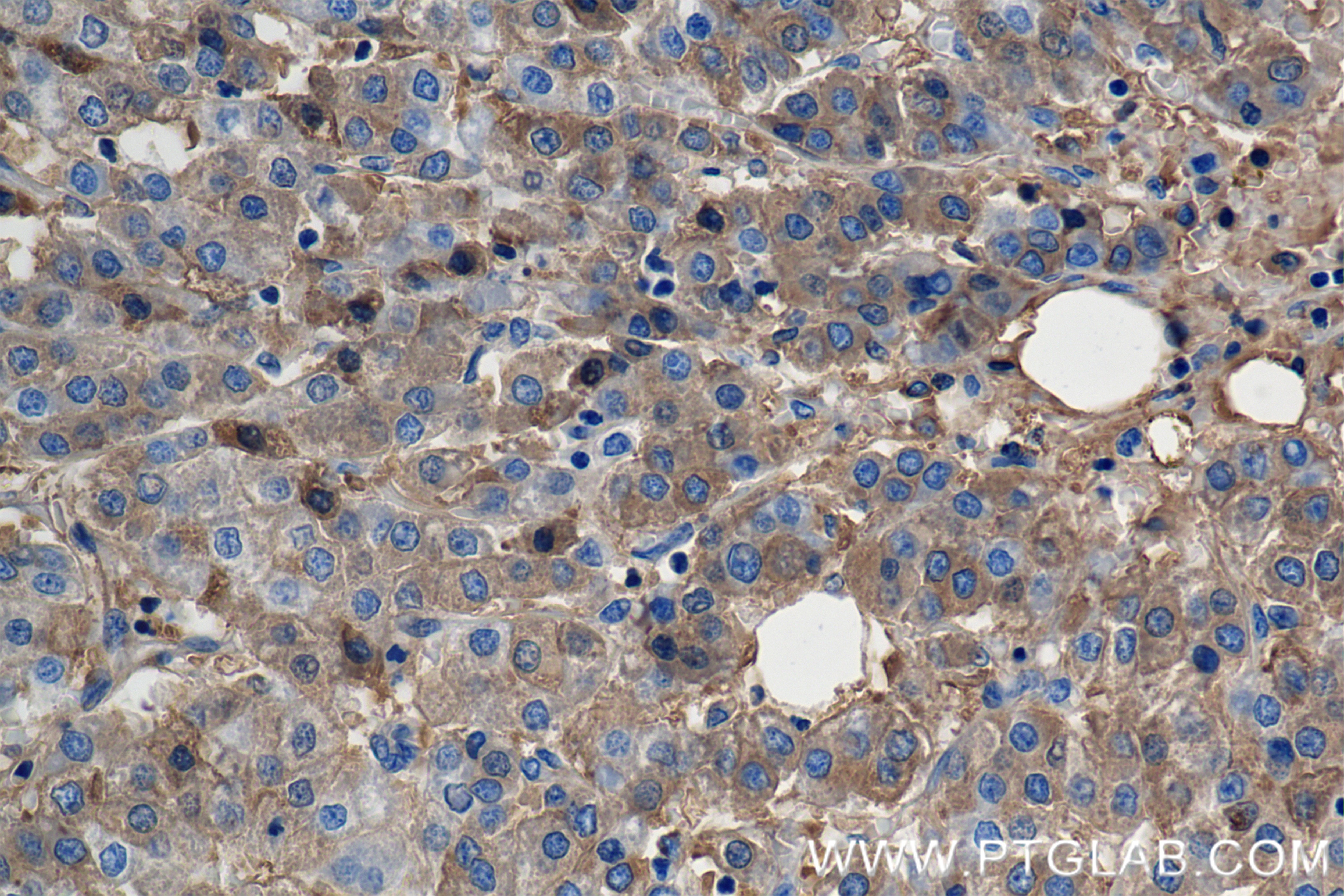 Immunohistochemistry (IHC) staining of Human Hepatocellular cancer using Albumin Recombinant antibody (82783-6-RR)
