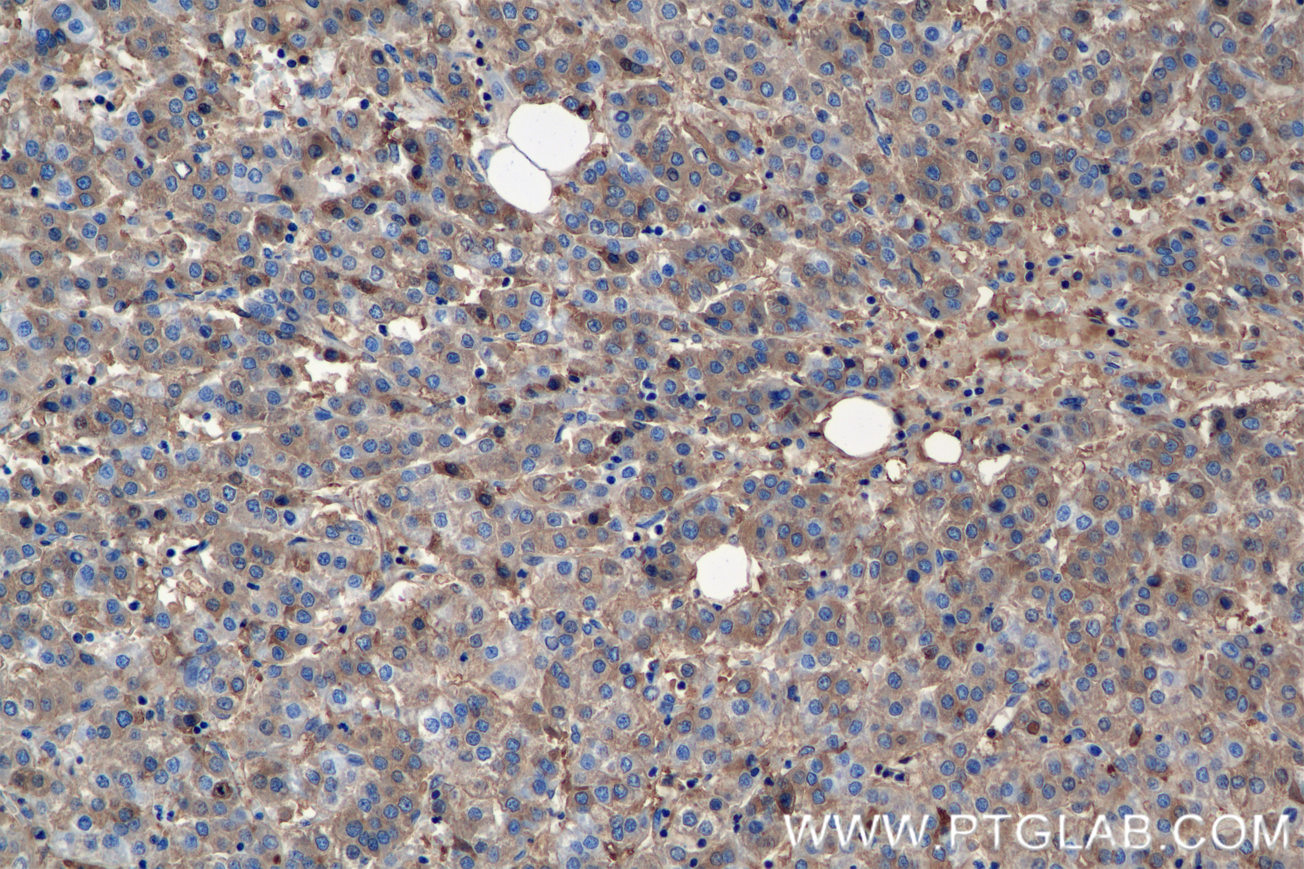 Immunohistochemistry (IHC) staining of Human Hepatocellular cancer using Albumin Recombinant antibody (82783-6-RR)