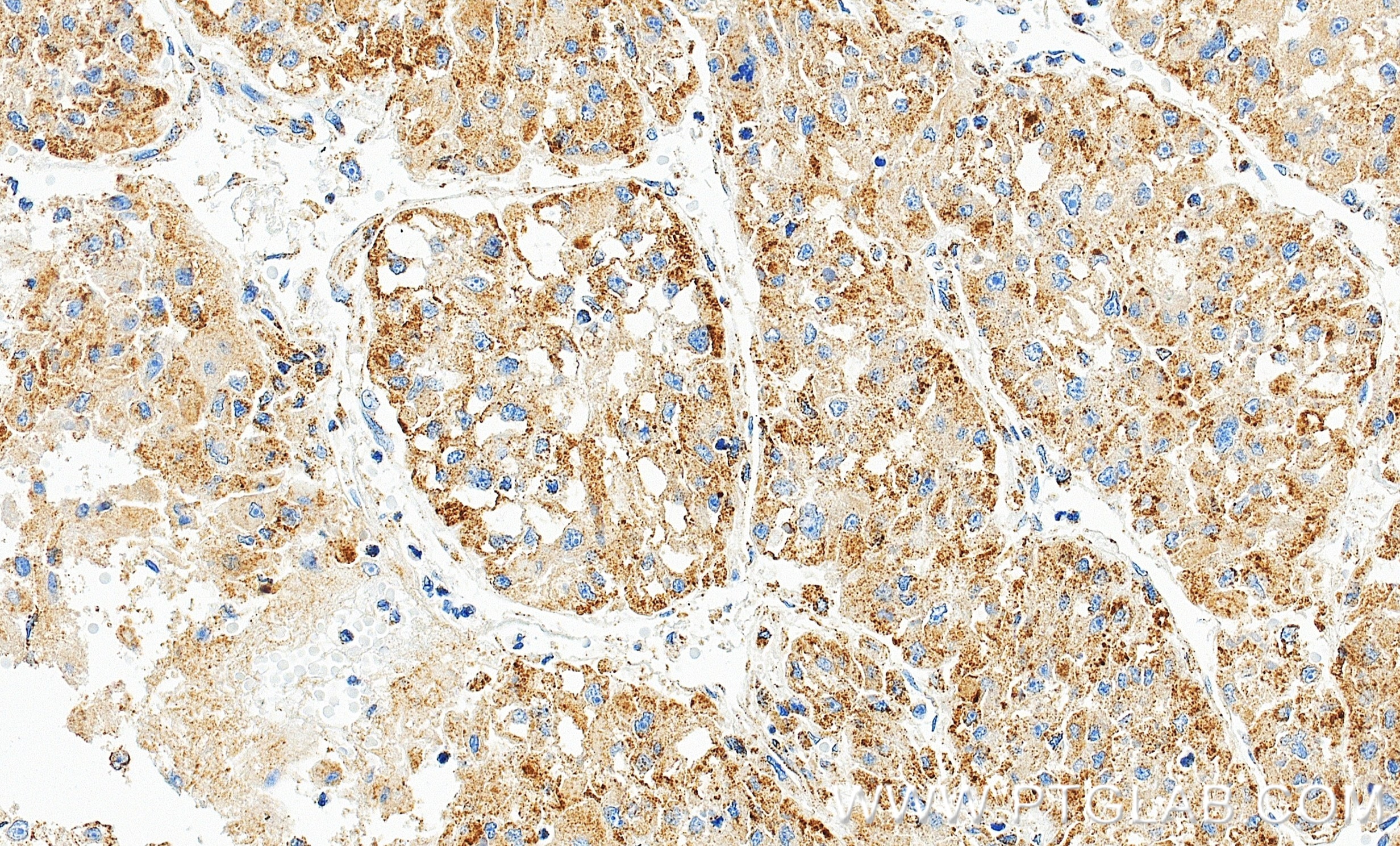 IHC staining of human liver cancer using 86472-3-RR Immunohistochemistry (IHC) staining of human liver cancer tissue using Alkyl-DHAP synthase/AGPS Recombinant monoclonal an (86472-3-RR)