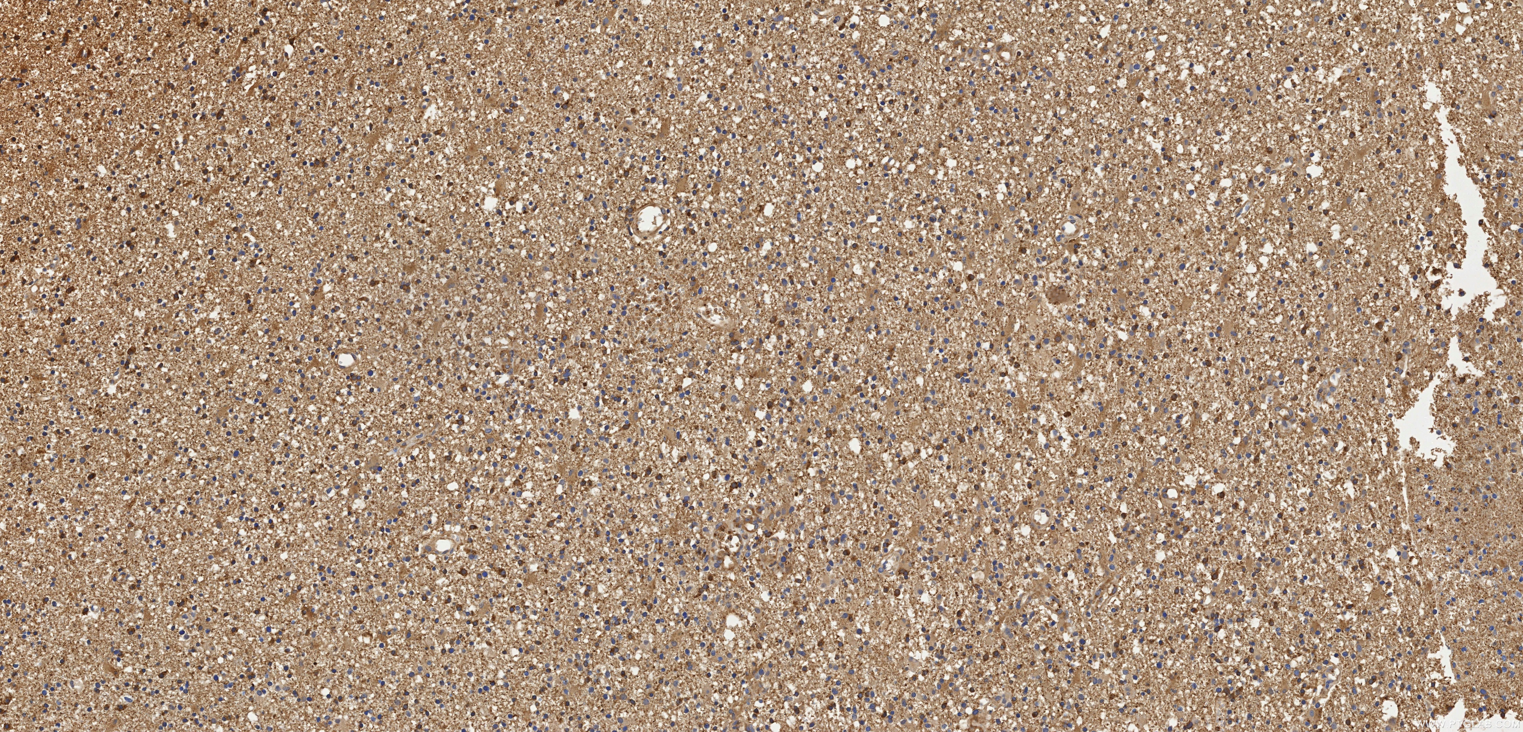 Immunohistochemistry (IHC) staining of Human brain cancer（Astrocitoma） using Anti-Human Alpha Synuclein Rabbit Recombinant Anti (98708-2-RR)