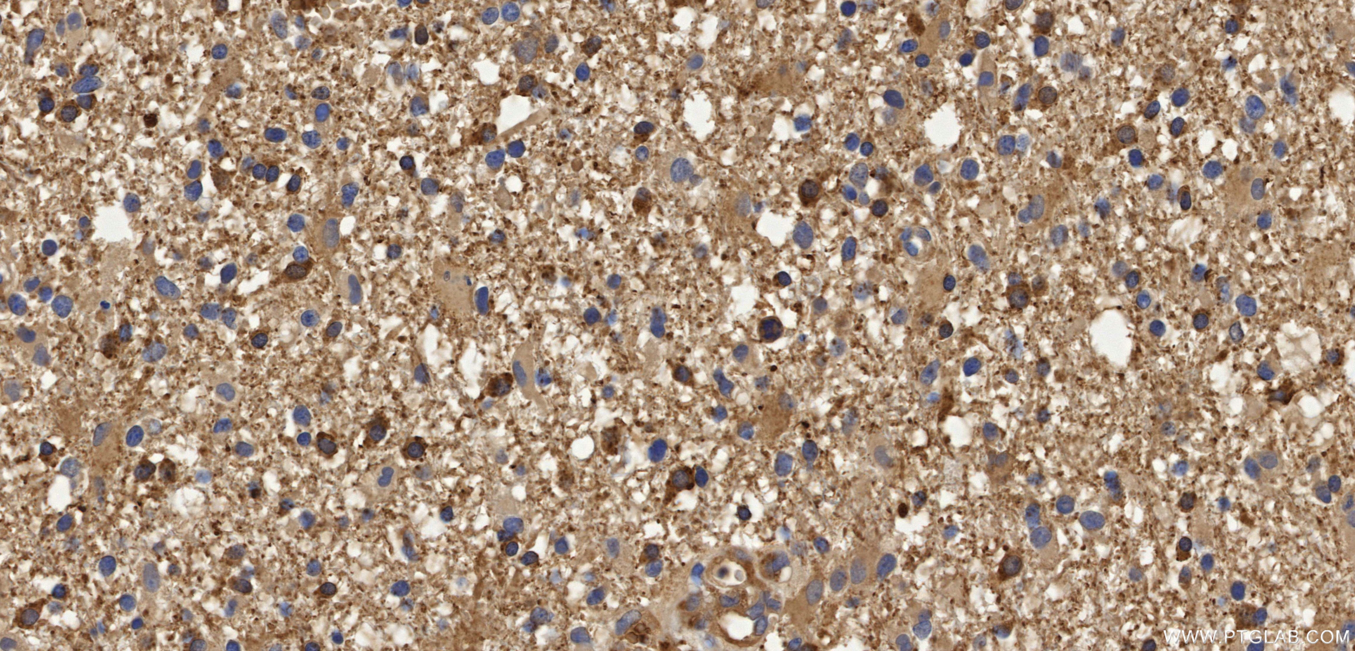 Immunohistochemistry (IHC) staining of Human brain cancer（Astrocitoma） using Anti-Human Alpha Synuclein Rabbit Recombinant Anti (98708-2-RR)