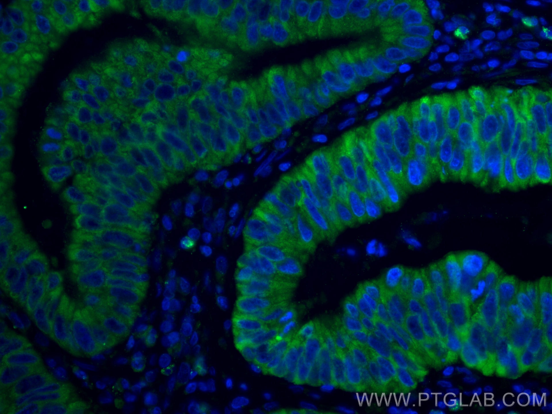 Immunofluorescence (IF) / fluorescent staining of human colon cancer tissue using CoraLite® Plus 488-conjugated Amphiregulin Polyclo (CL488-16036)