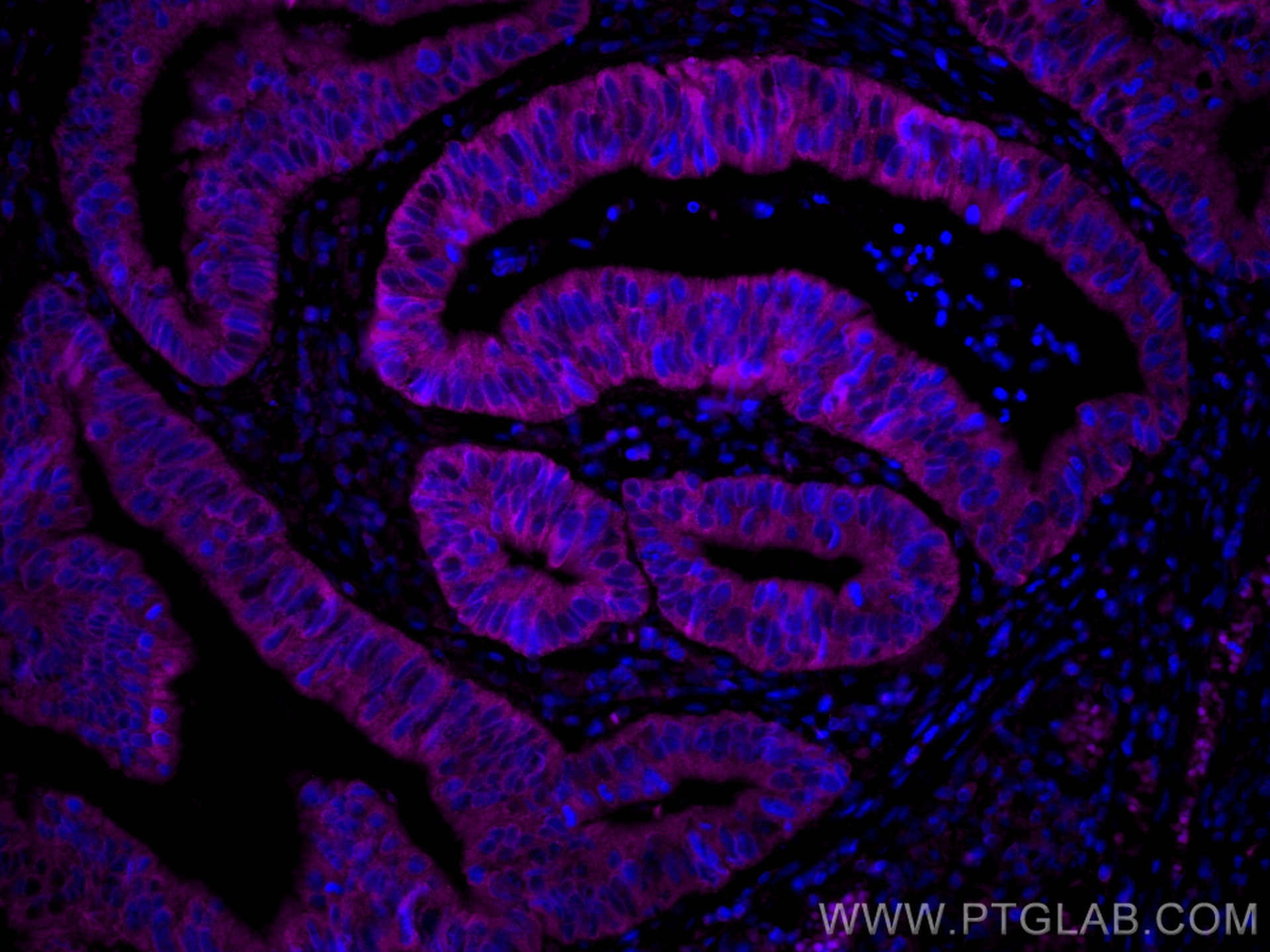 Immunofluorescence (IF) / fluorescent staining of human colon cancer tissue using CoraLite® Plus 647-conjugated Amphiregulin Polyclo (CL647-16036)