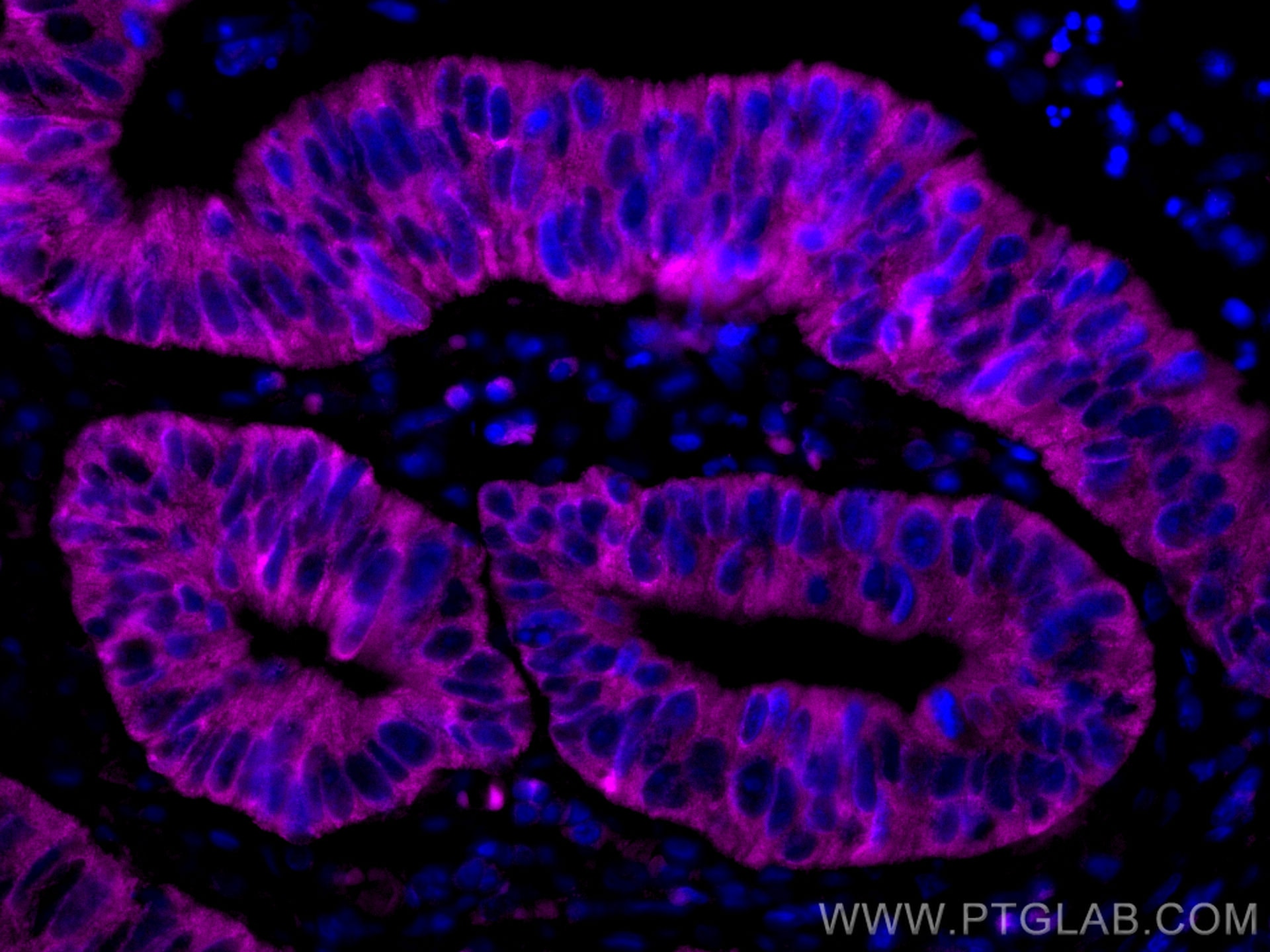 Immunofluorescence (IF) / fluorescent staining of human colon cancer tissue using CoraLite® Plus 647-conjugated Amphiregulin Polyclo (CL647-16036)