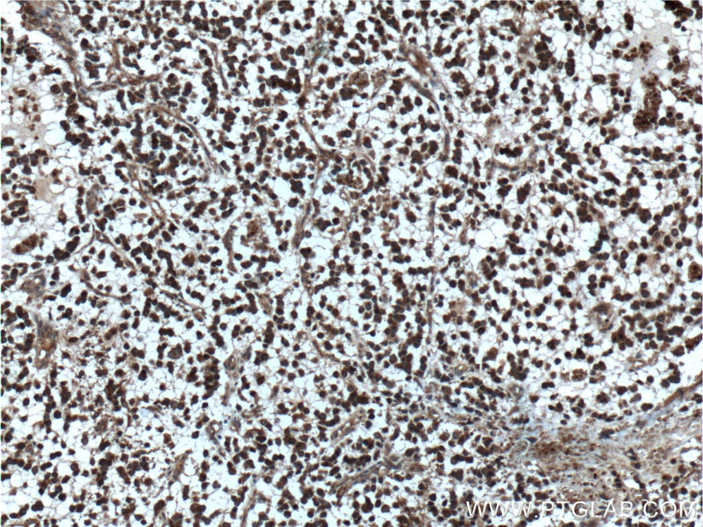Immunohistochemistry (IHC) staining of human gliomas tissue using APP/Beta Amyloid Polyclonal antibody (25524-1-AP)
