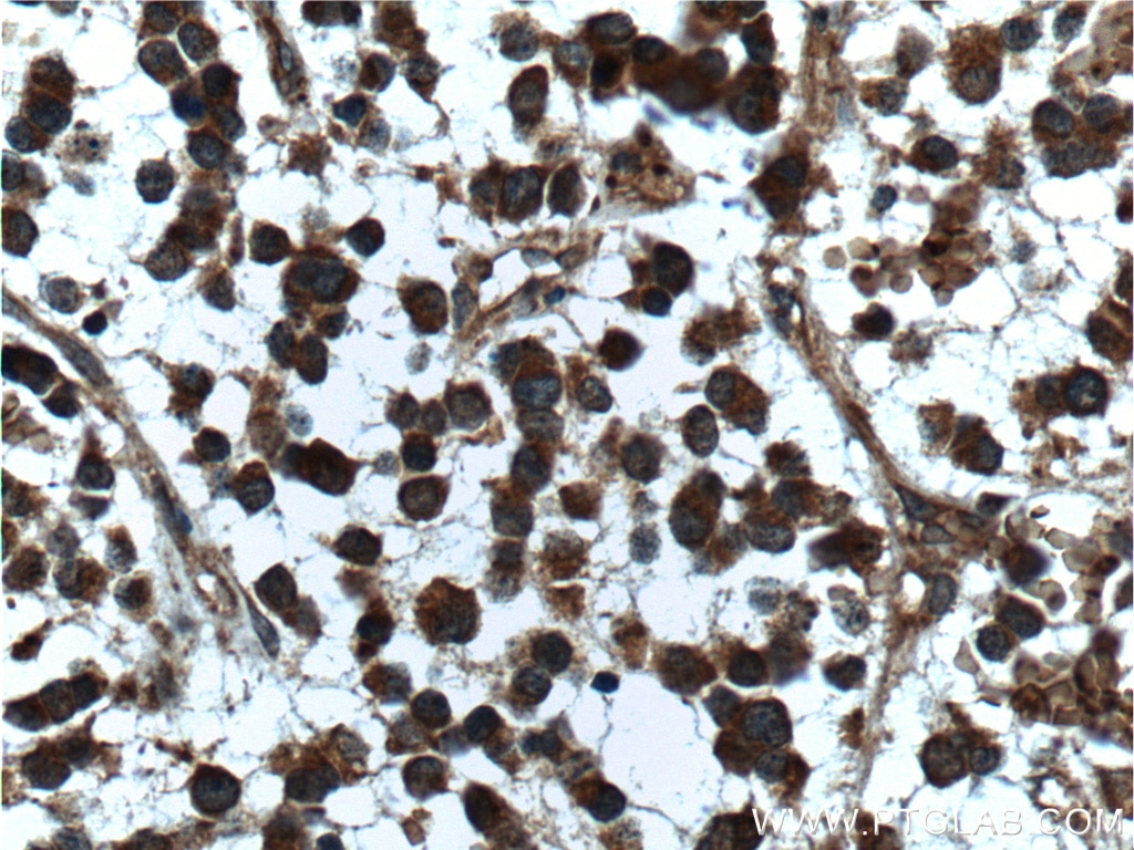 Immunohistochemistry (IHC) staining of human gliomas tissue using APP/Beta Amyloid Polyclonal antibody (25524-1-AP)