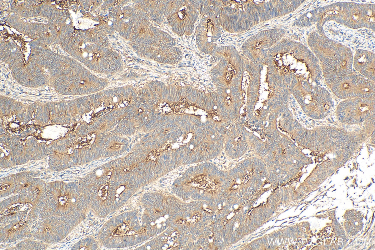Immunohistochemistry (IHC) staining of human colon cancer tissue using Angiopoietin 1 Polyclonal antibody (27093-1-AP)