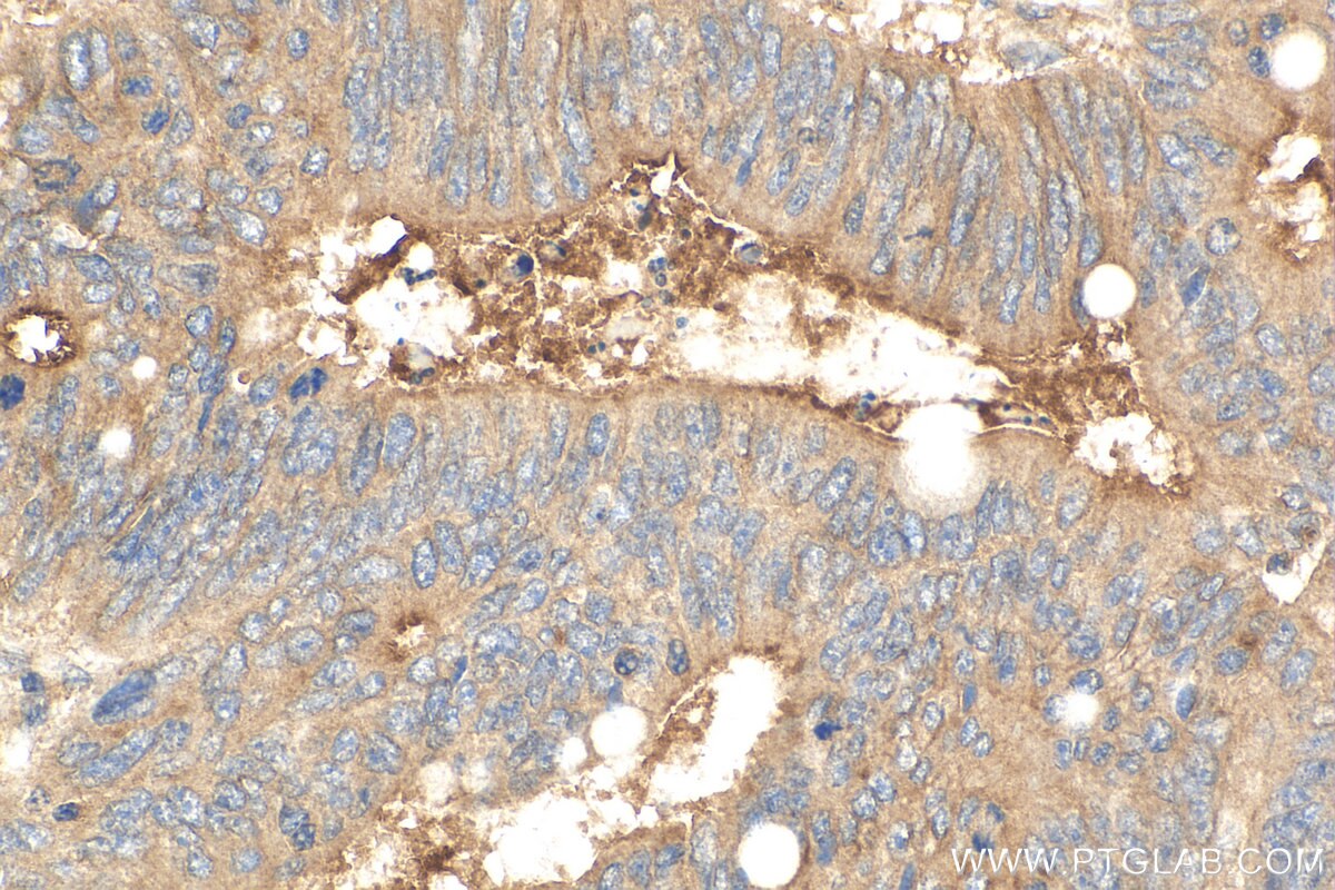 Immunohistochemistry (IHC) staining of human colon cancer tissue using Angiopoietin 1 Polyclonal antibody (27093-1-AP)