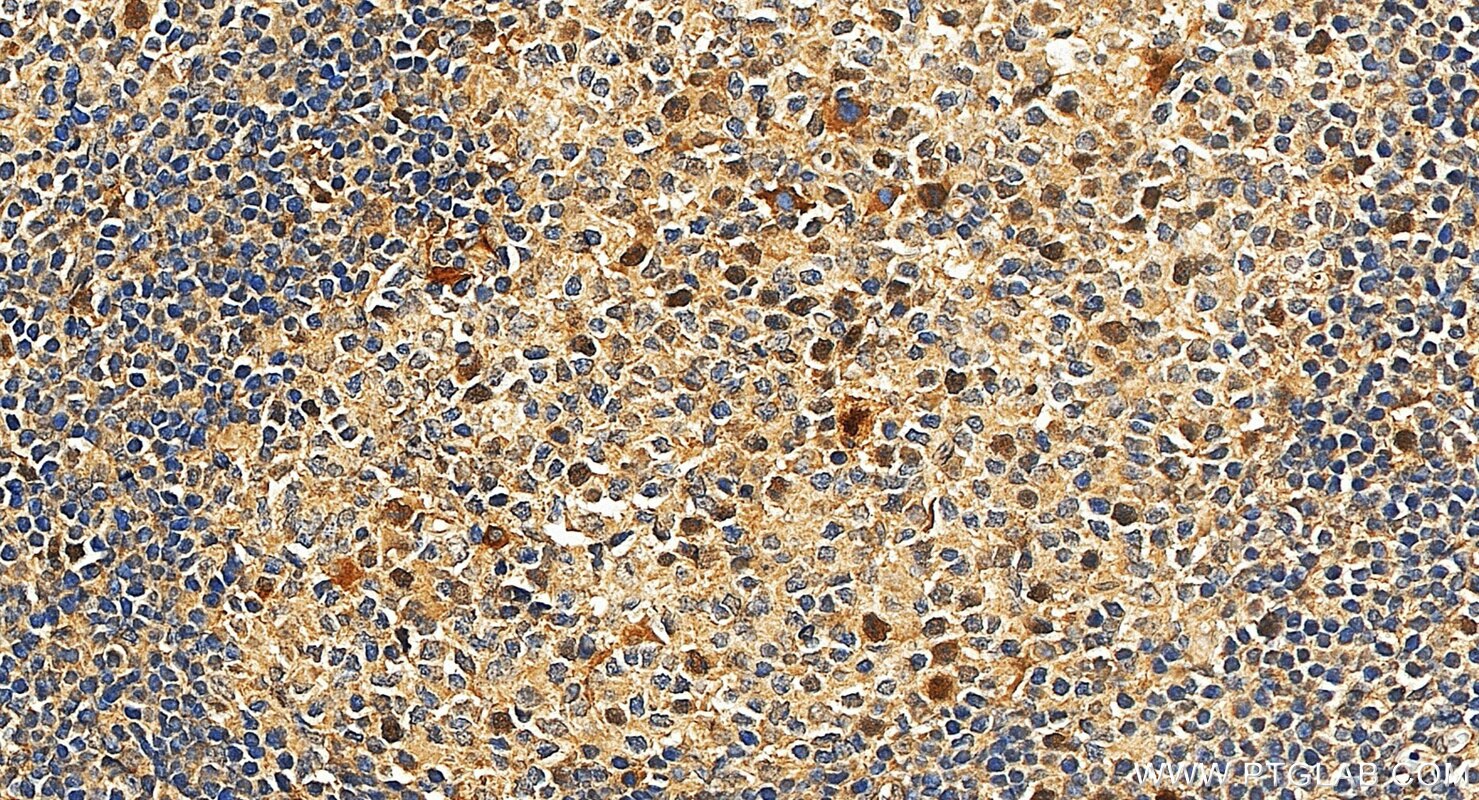 IHC staining of human tonsillitis using 34707-1-AP Immunohistochemistry (IHC) staining of human tonsillitis tissue using Anillin Polyclonal antibody (34707-1-AP)