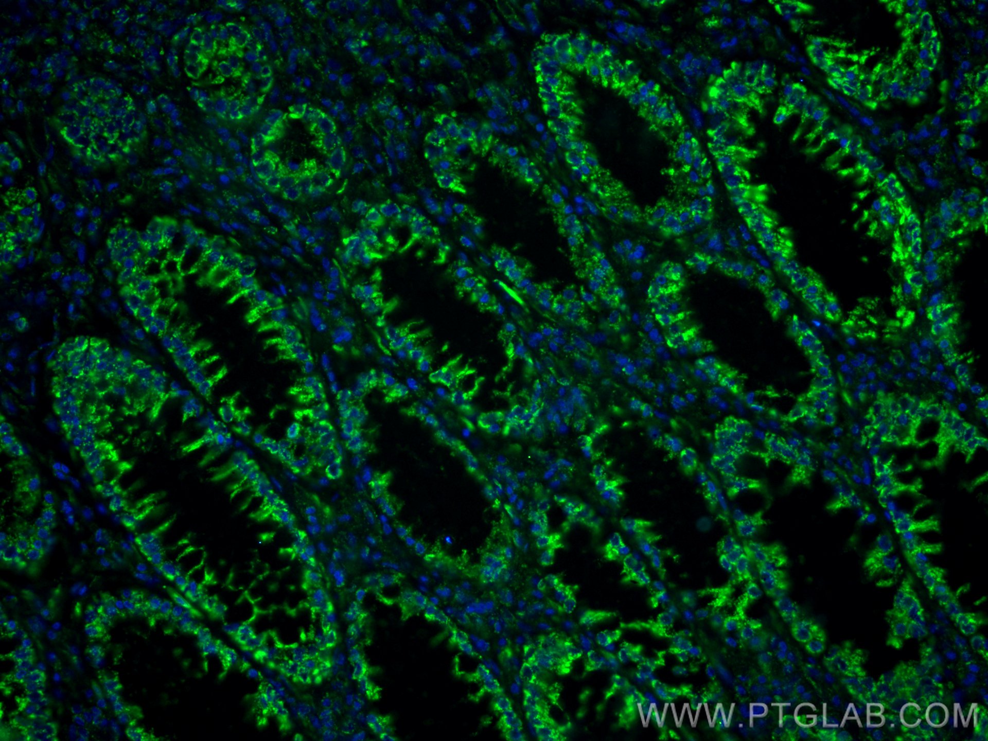 Immunofluorescence (IF) / fluorescent staining of human colon cancer tissue using Annexin A10 Monoclonal antibody (66869-1-Ig)