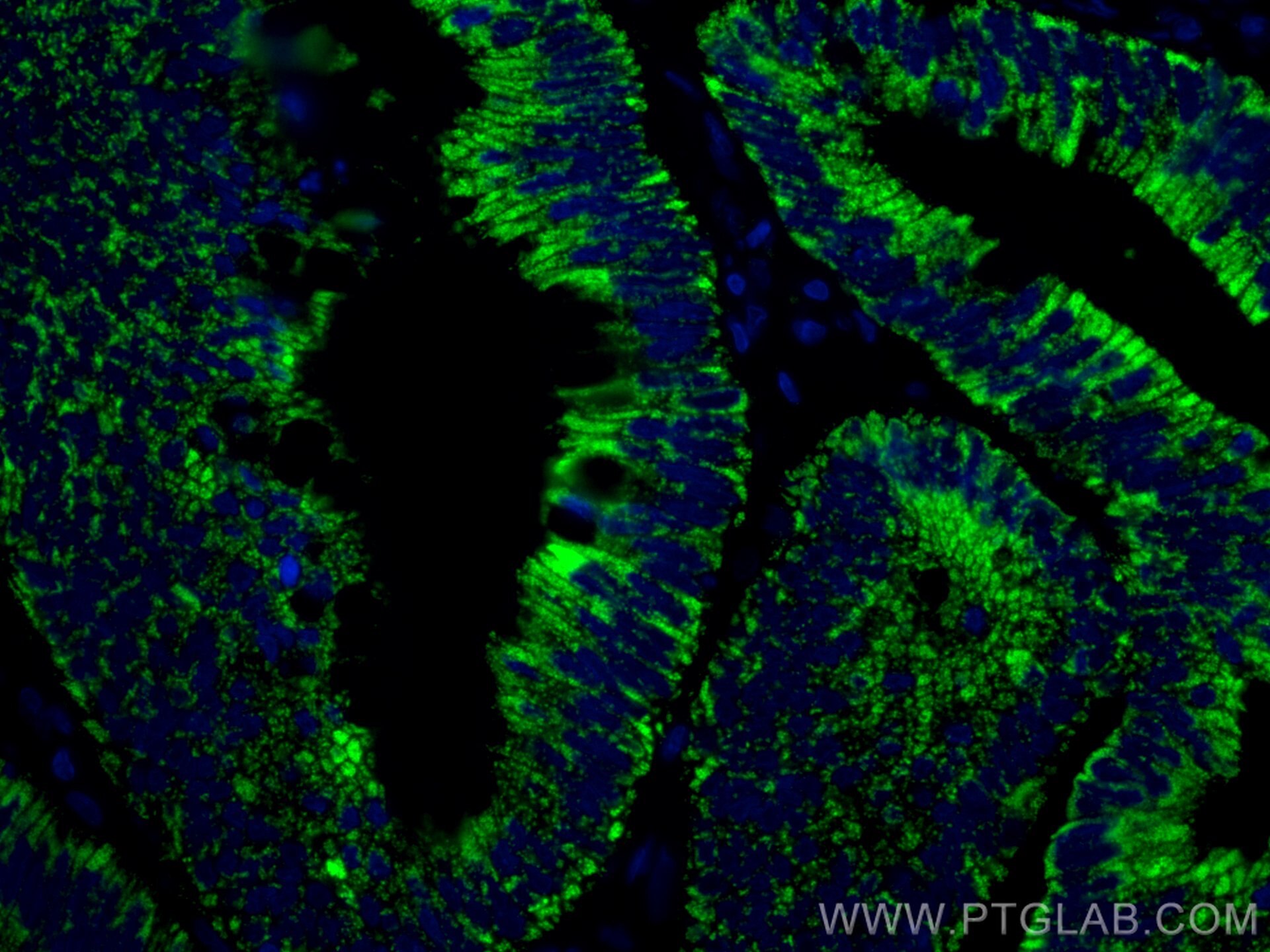 Immunofluorescence (IF) / fluorescent staining of human colon cancer tissue using Annexin A10 Monoclonal antibody (66869-1-Ig)