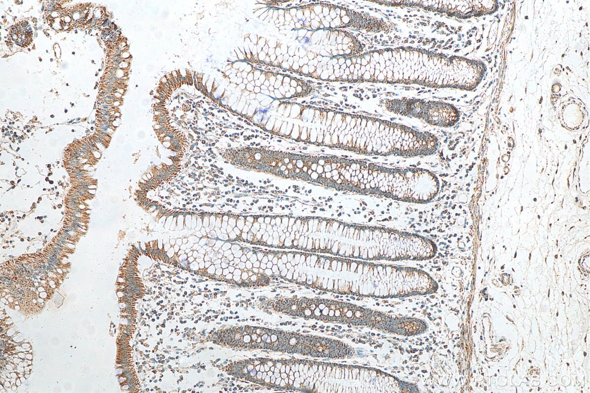 Immunohistochemistry (IHC) staining of human colon cancer tissue using Annexin A10 Monoclonal antibody (66869-1-Ig)