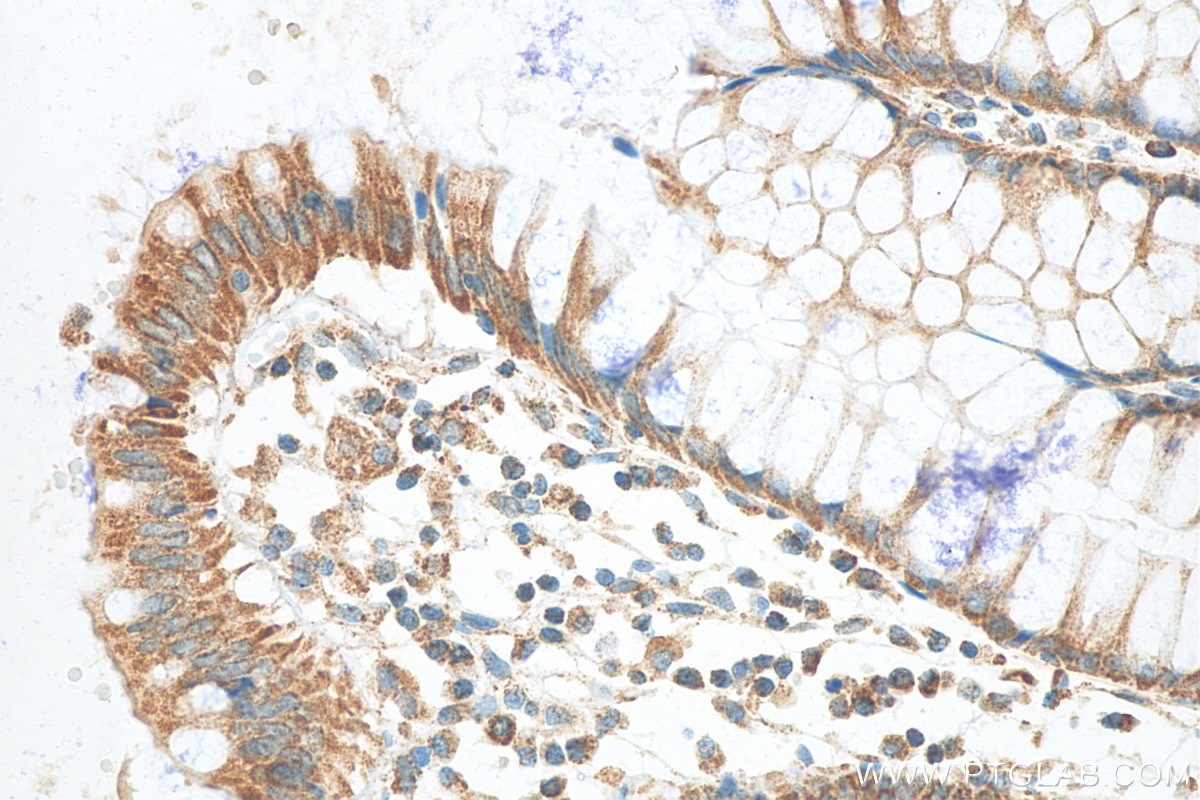 Immunohistochemistry (IHC) staining of human colon cancer tissue using Annexin A10 Monoclonal antibody (66869-1-Ig)