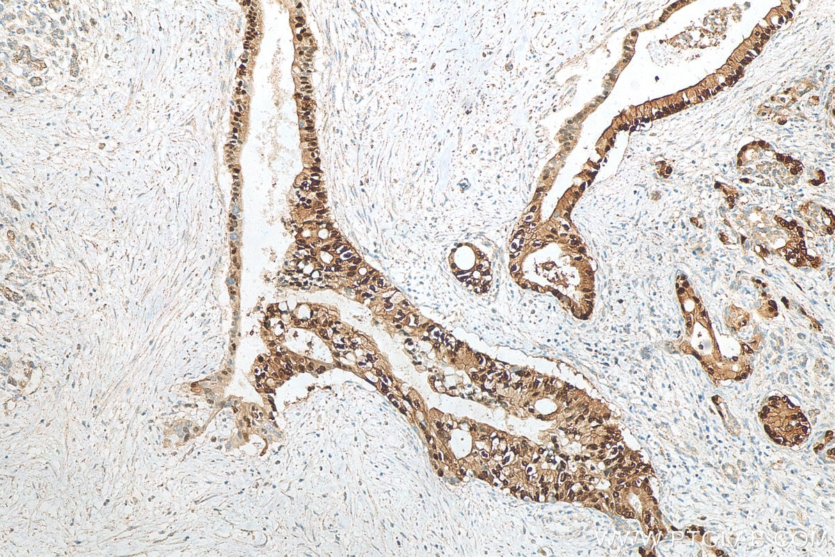 Immunohistochemistry (IHC) staining of human pancreas cancer tissue using Annexin A10 Monoclonal antibody (66869-1-Ig)
