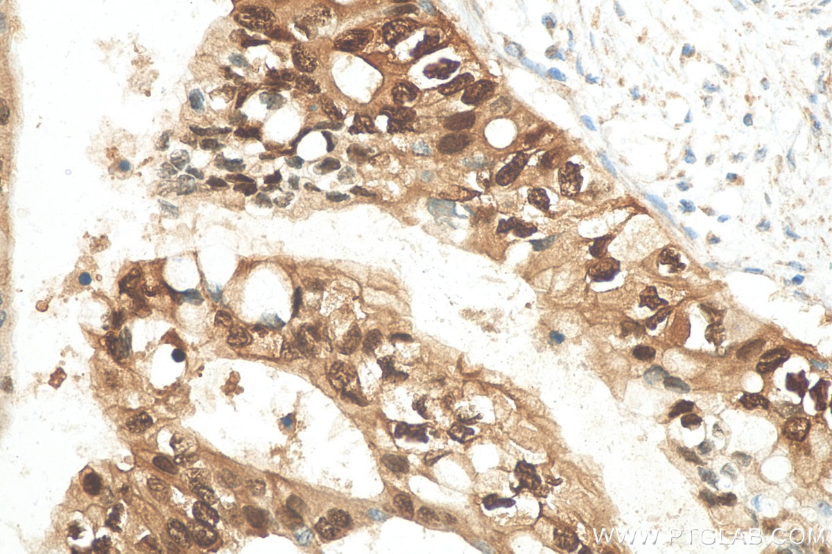 Immunohistochemistry (IHC) staining of human pancreas cancer tissue using Annexin A10 Monoclonal antibody (66869-1-Ig)