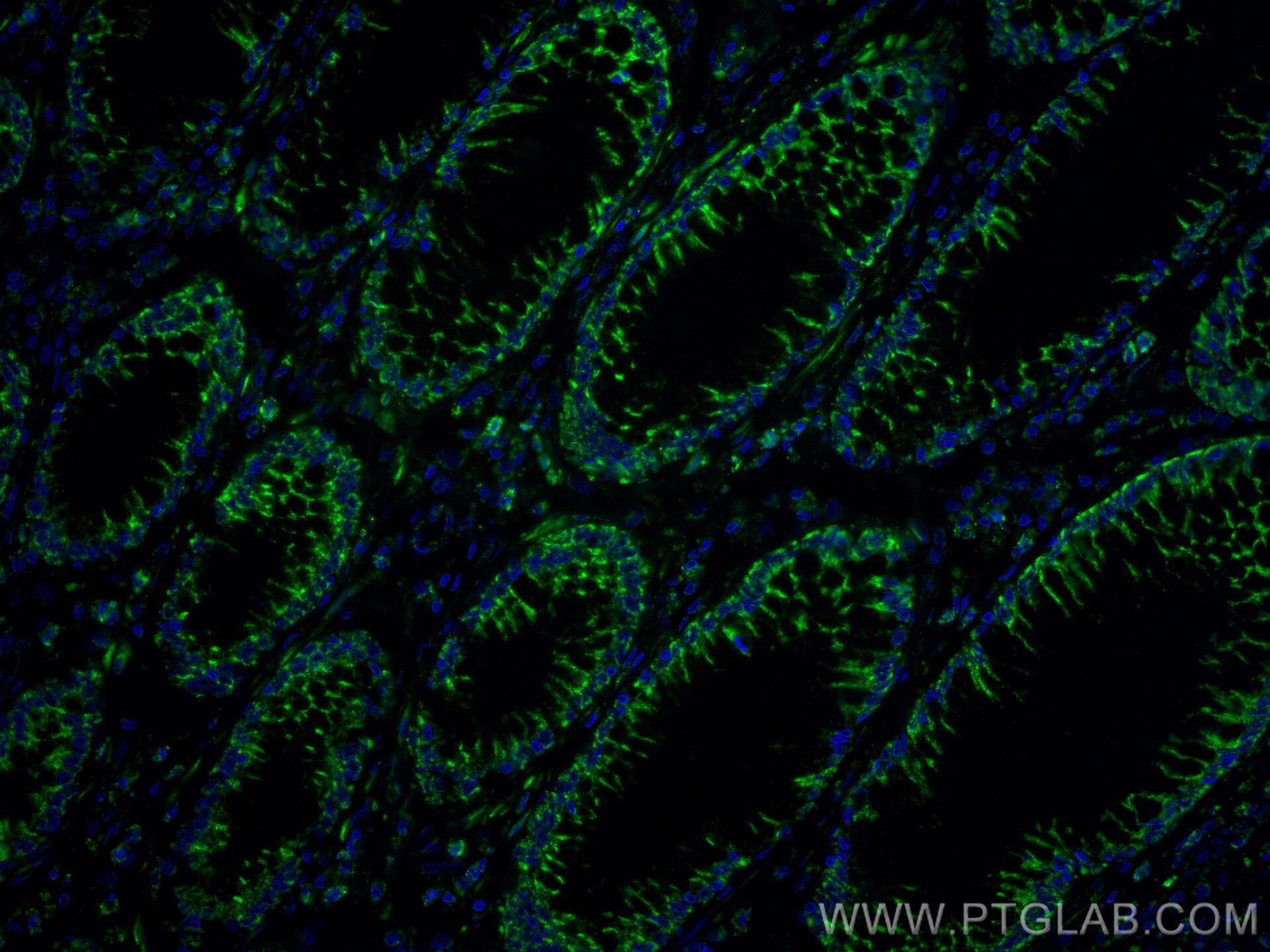 Immunofluorescence (IF) / fluorescent staining of human colon cancer tissue using CoraLite® Plus 488-conjugated Annexin A10 Monoclon (CL488-66869)