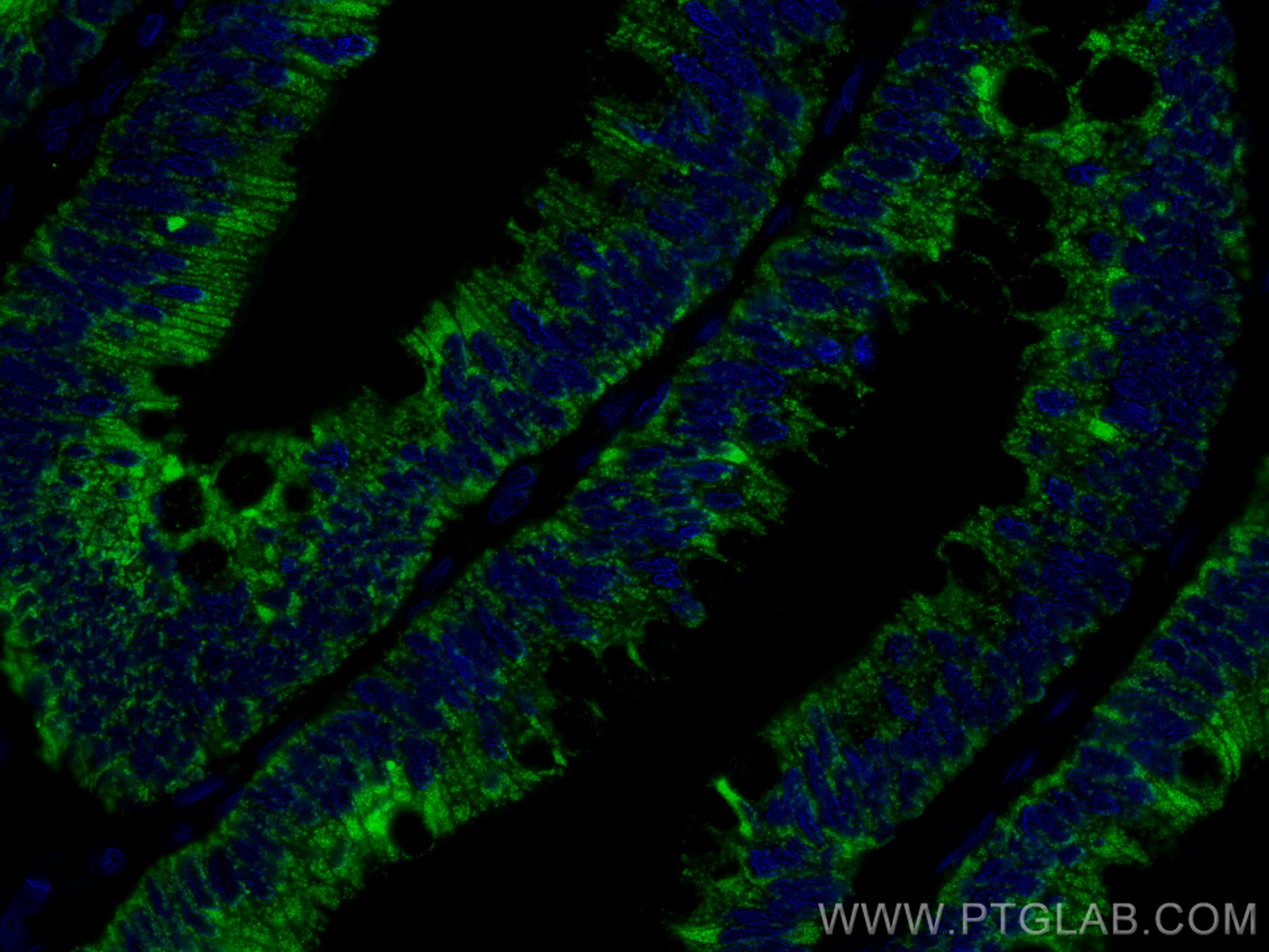 Immunofluorescence (IF) / fluorescent staining of human colon cancer tissue using CoraLite® Plus 488-conjugated Annexin A10 Monoclon (CL488-66869)