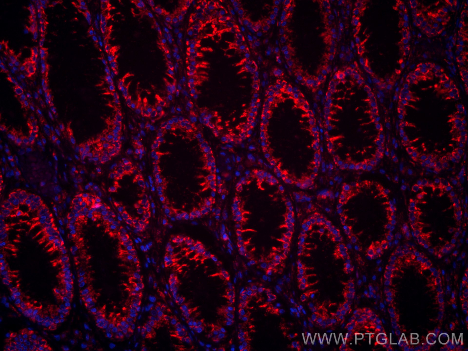 Immunofluorescence (IF) / fluorescent staining of human colon cancer tissue using CoraLite®594-conjugated Annexin A10 Monoclonal ant (CL594-66869)