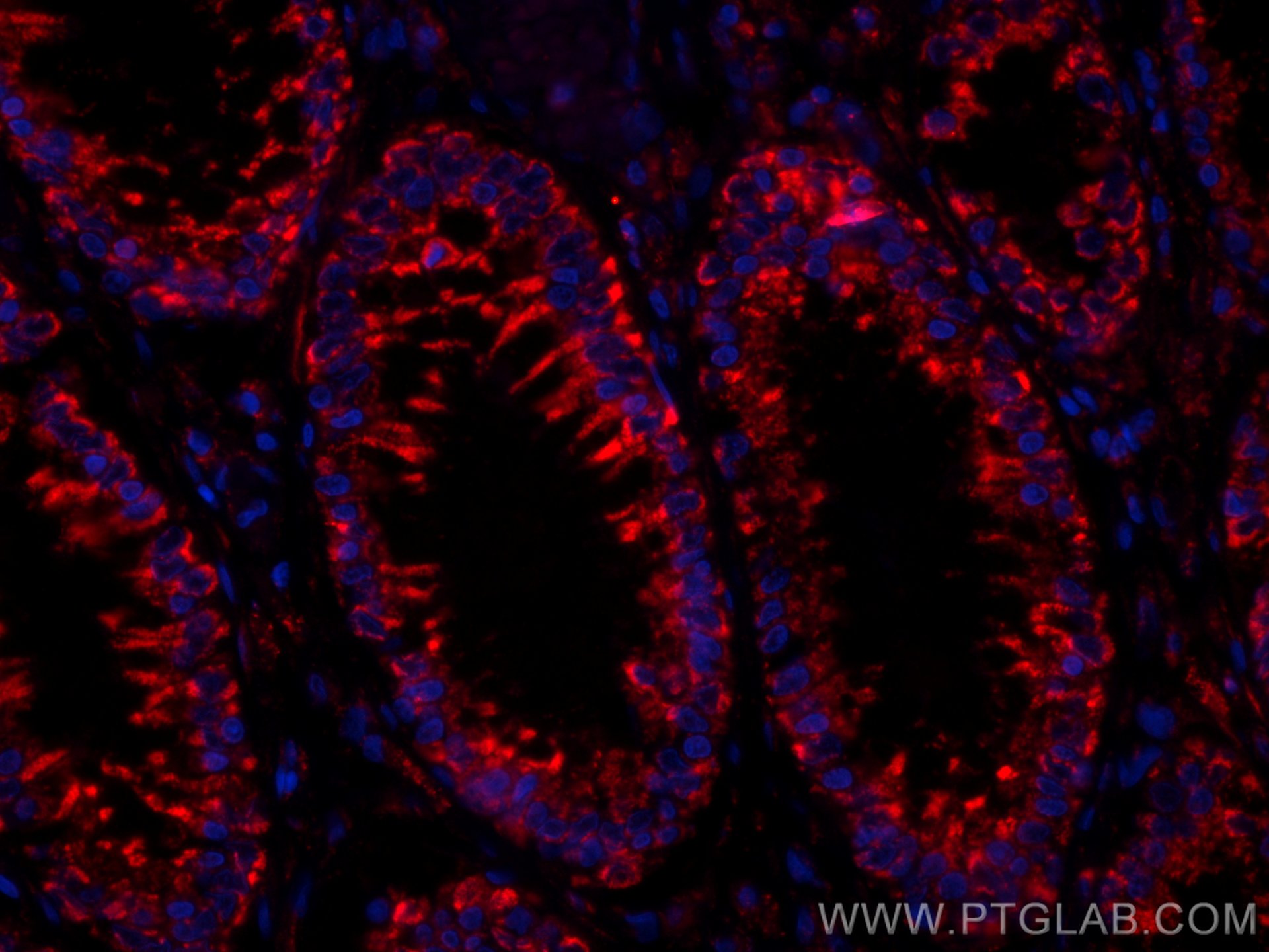 Immunofluorescence (IF) / fluorescent staining of human colon cancer tissue using CoraLite®594-conjugated Annexin A10 Monoclonal ant (CL594-66869)