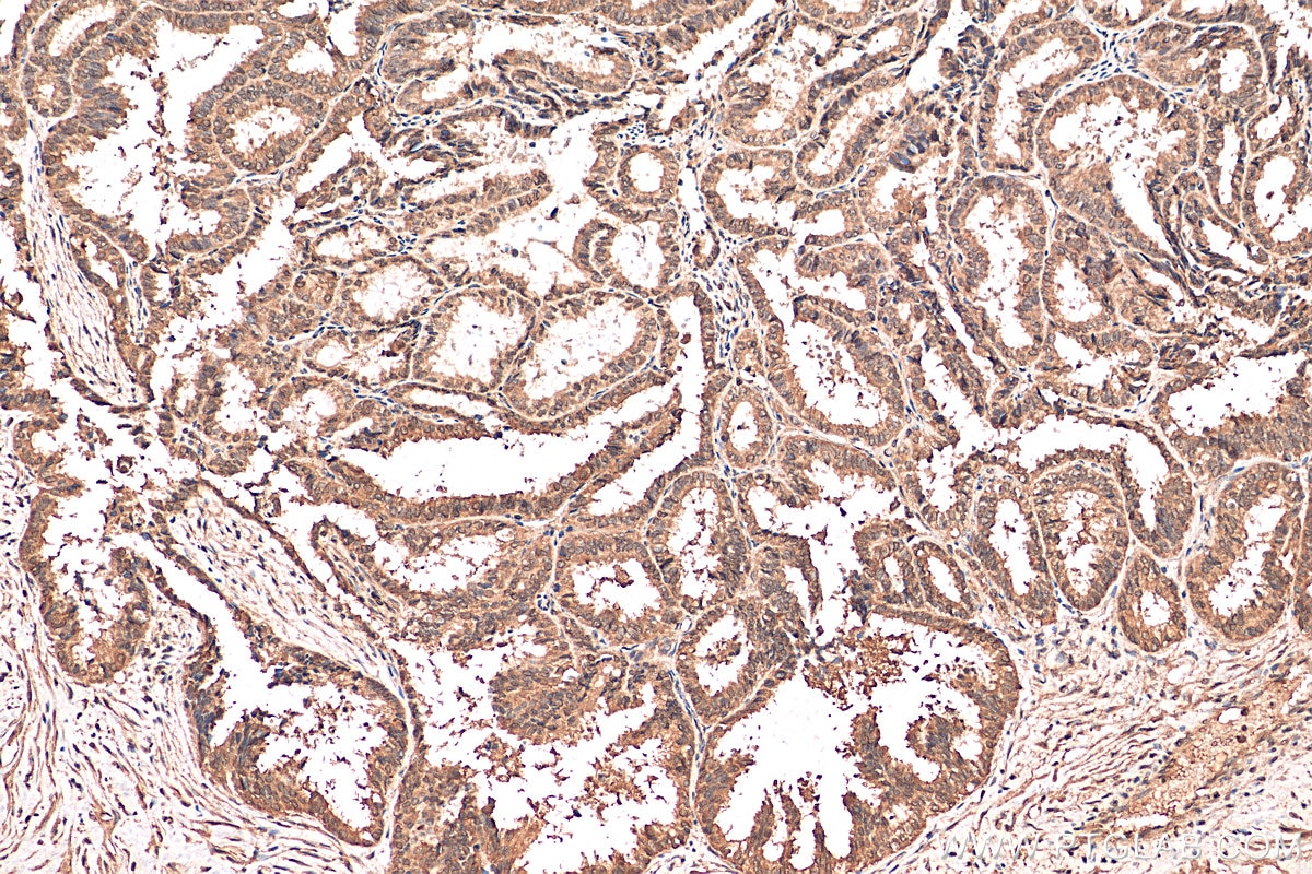 Immunohistochemistry (IHC) staining of human ovary tumor tissue using Annexin A11 Monoclonal antibody (68089-1-Ig)