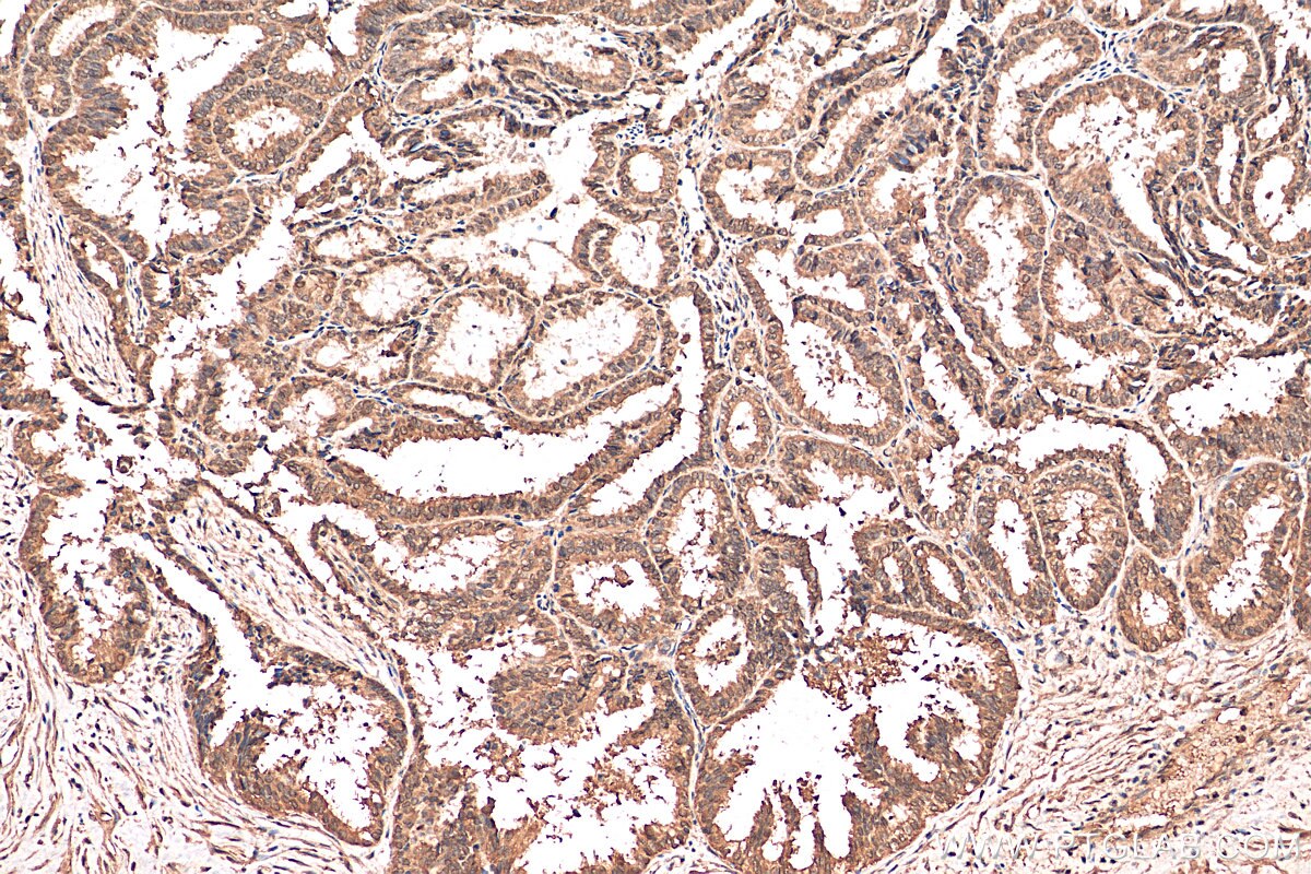 IHC staining of human ovary tumor using 68089-1-Ig