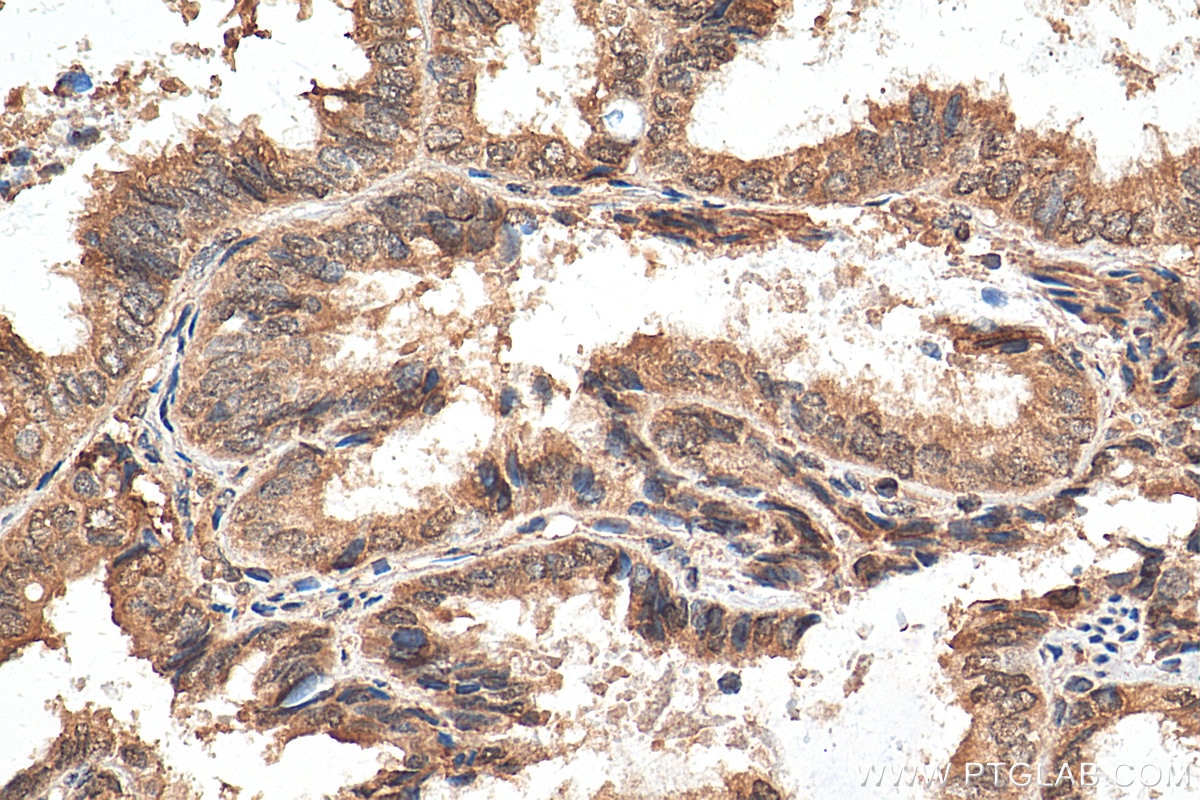 Immunohistochemistry (IHC) staining of human ovary tumor tissue using Annexin A11 Monoclonal antibody (68089-1-Ig)