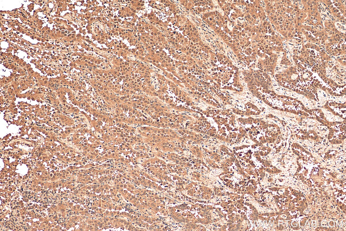 Immunohistochemistry (IHC) staining of human lung cancer tissue using Annexin A11 Monoclonal antibody (68089-1-Ig)