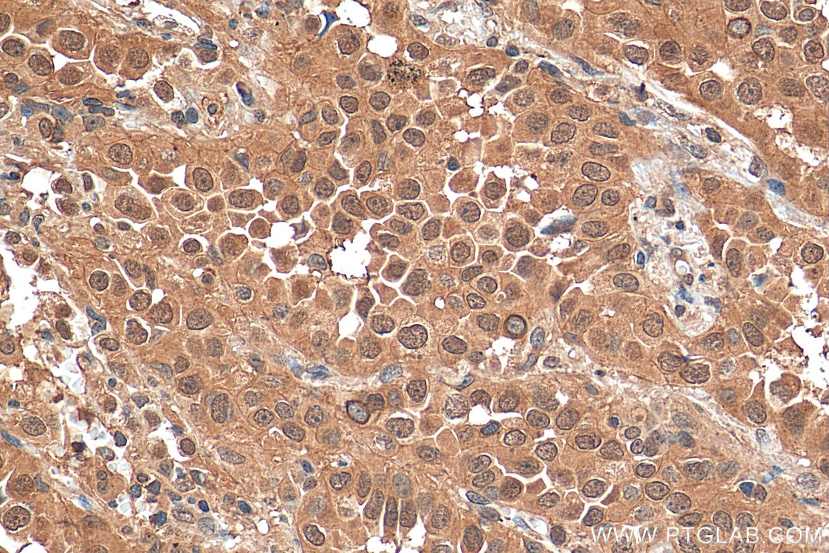 Immunohistochemistry (IHC) staining of human lung cancer tissue using Annexin A11 Monoclonal antibody (68089-1-Ig)
