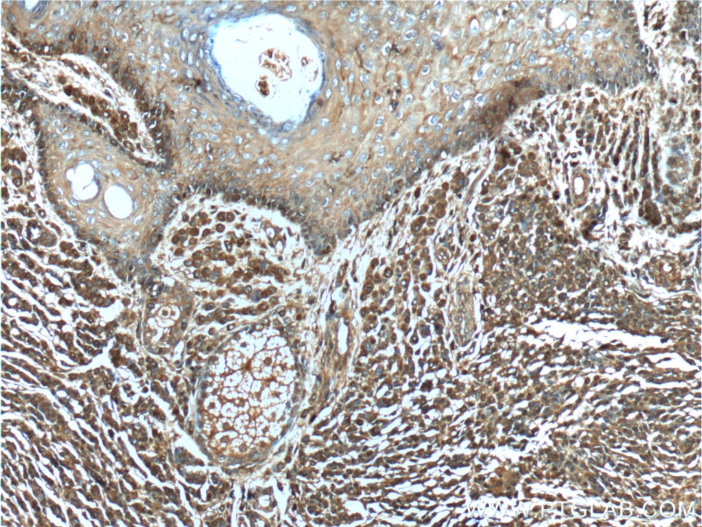 Immunohistochemistry (IHC) staining of human malignant melanoma tissue using Annexin V Monoclonal antibody (66245-1-Ig)