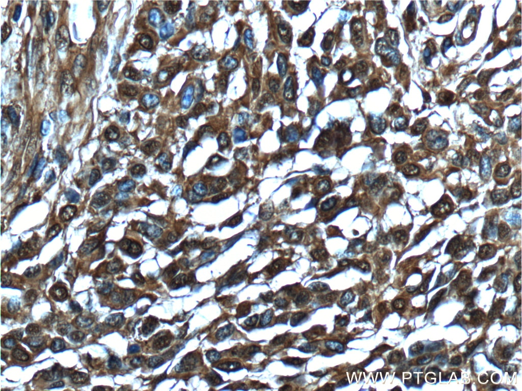 Immunohistochemistry (IHC) staining of human malignant melanoma tissue using Annexin V Monoclonal antibody (66245-1-Ig)