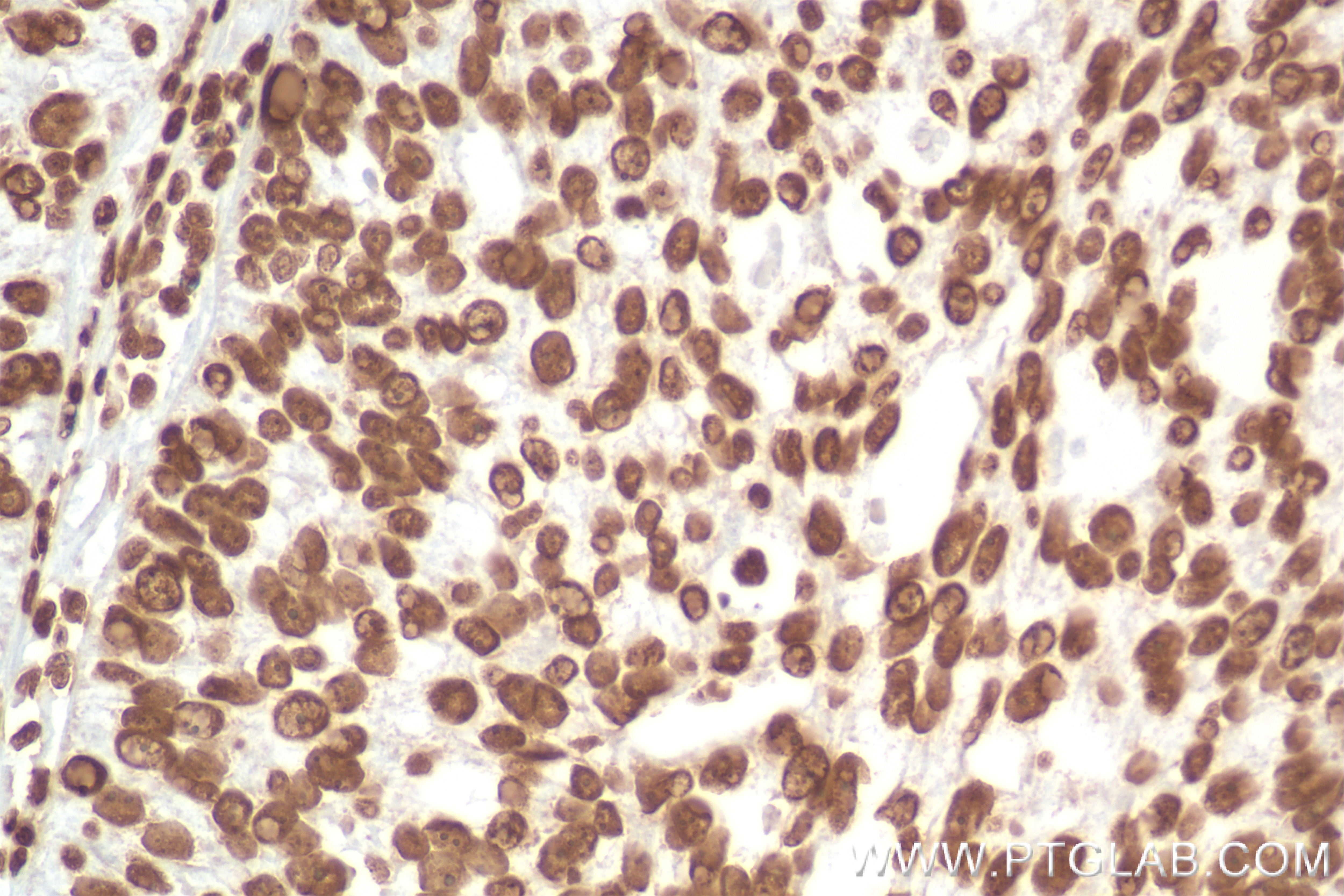 Immunohistochemistry (IHC) staining of human ovary tumor tissue using Anti-DNA Recombinant antibody (85854-1-RR)