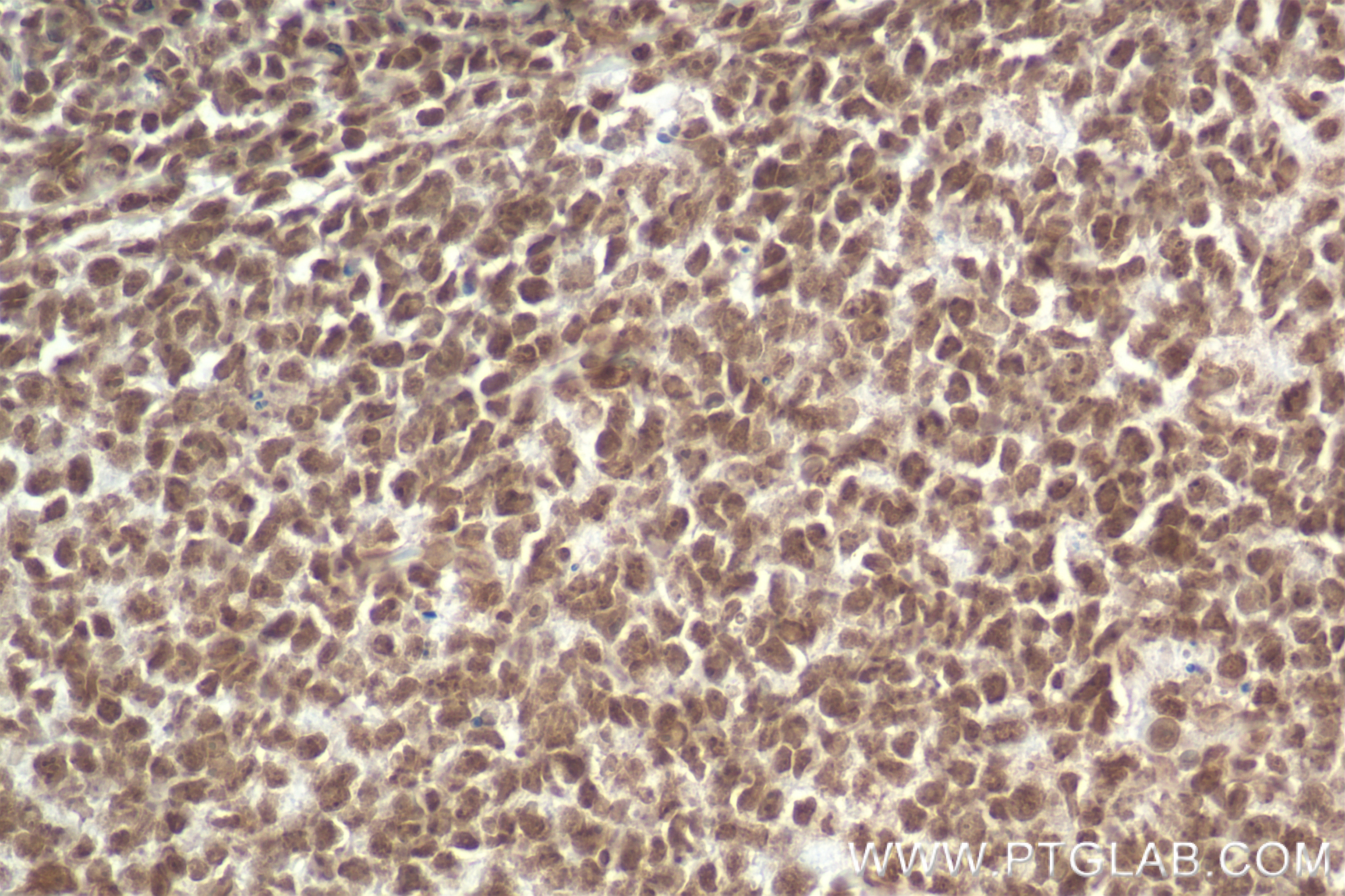 Immunohistochemistry (IHC) staining of human tonsillitis tissue using Anti-DNA Recombinant antibody (85854-1-RR)