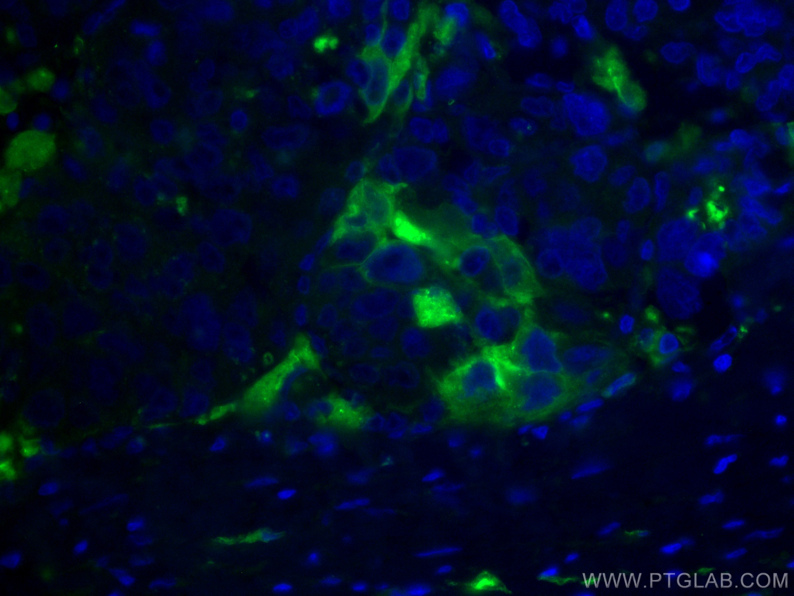 Immunofluorescence (IF) / fluorescent staining of human liver cancer tissue using CoraLite® Plus 488-conjugated Apolipoprotein H Mon (CL488-66074)