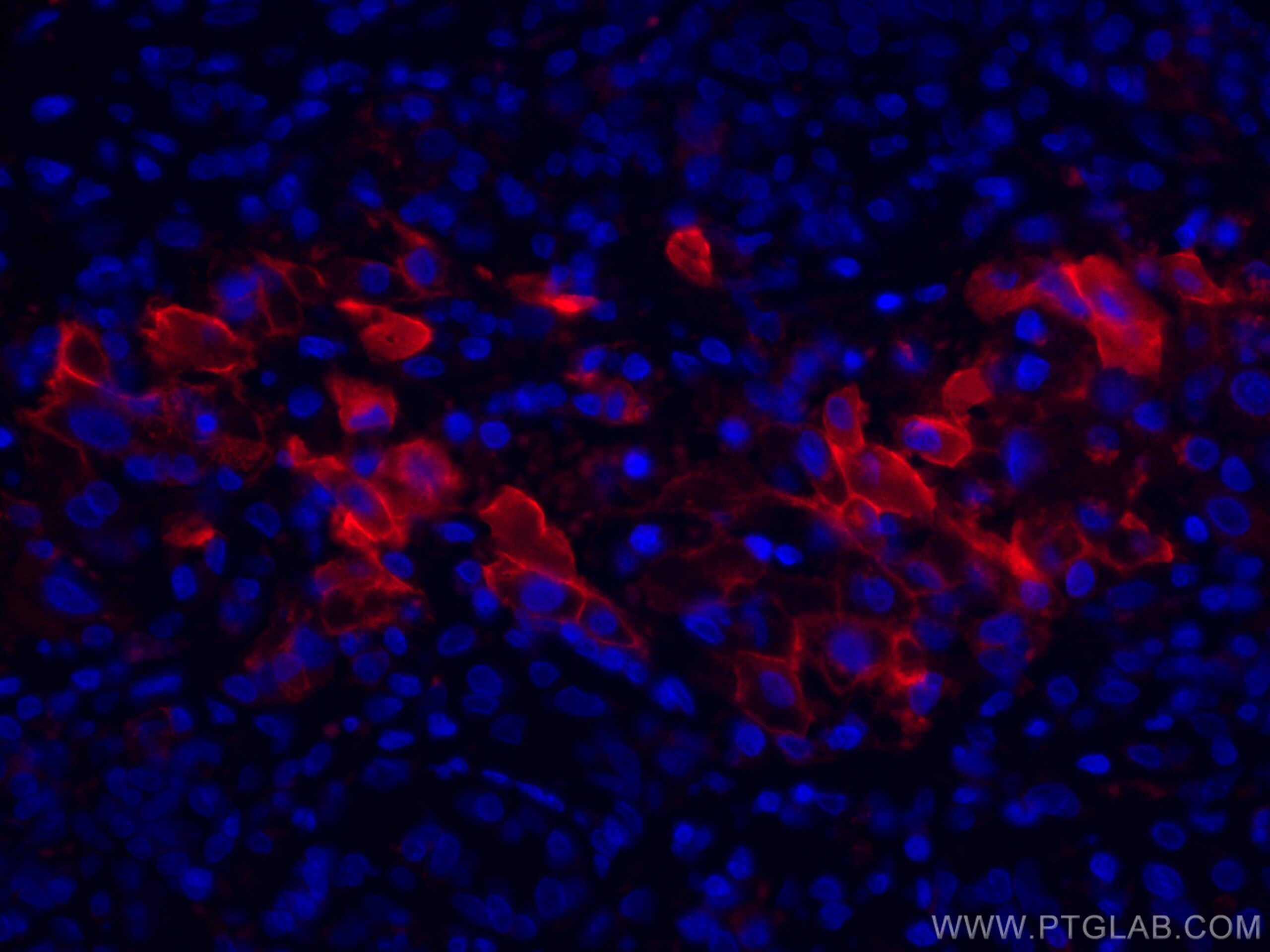 Immunofluorescence (IF) / fluorescent staining of human liver cancer tissue using CoraLite®594-conjugated Apolipoprotein H Monoclona (CL594-66074)