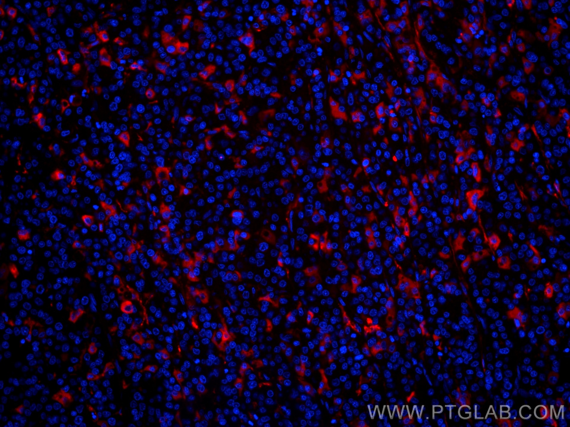 Immunofluorescence (IF) / fluorescent staining of human liver cancer tissue using CoraLite®594-conjugated Apolipoprotein H Monoclona (CL594-66074)