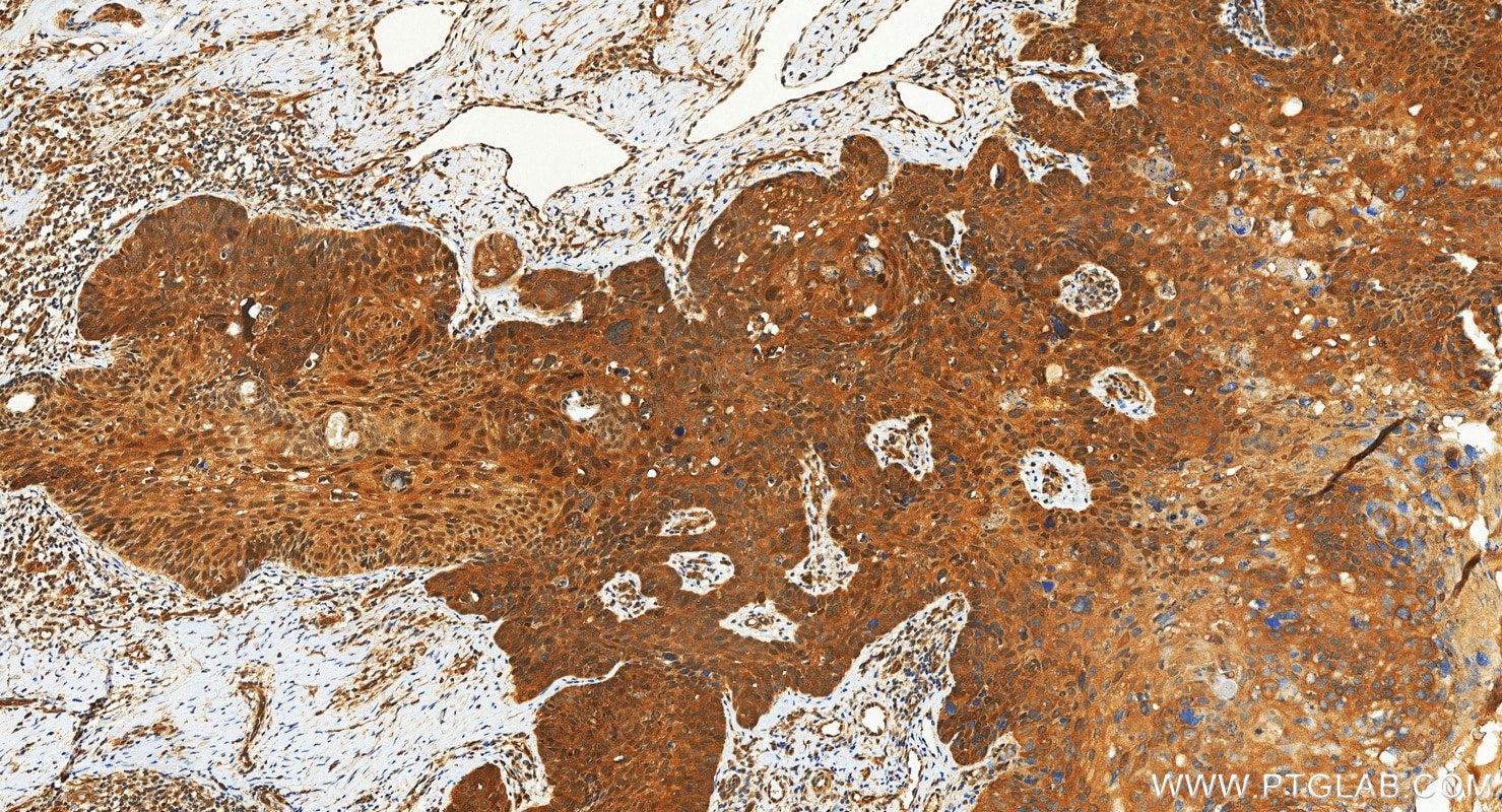 IHC staining of human bowen disease using 87817-1-RR Immunohistochemistry (IHC) staining of human bowen disease tissue using Ataxin-3/ATXN3 Recombinant monoclonal antibody (87817-1-RR)