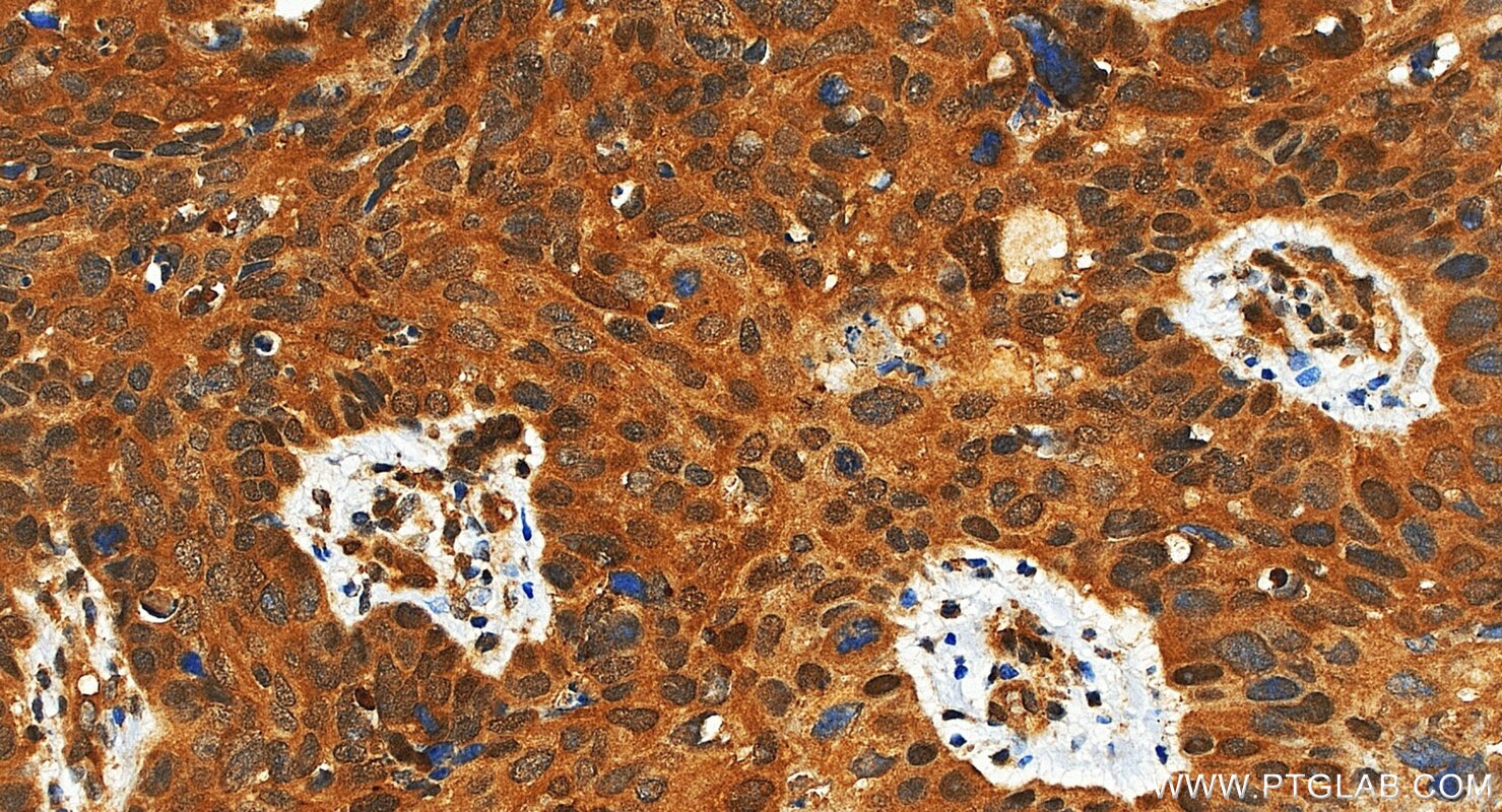 IHC staining of human bowen disease using 87817-1-RR Immunohistochemistry (IHC) staining of human bowen disease tissue using Ataxin-3/ATXN3 Recombinant monoclonal antibody (87817-1-RR)