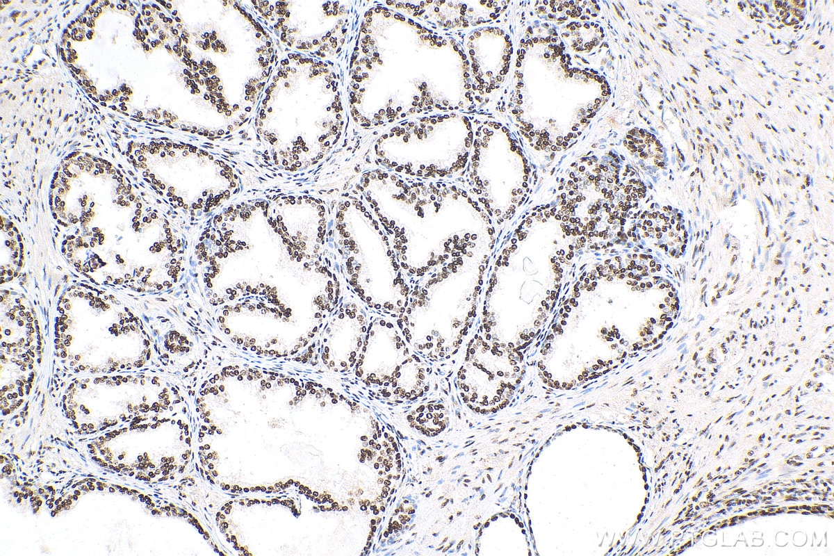 Immunohistochemistry (IHC) staining of human prostate cancer tissue using B23/NPM1 Recombinant antibody (82030-1-RR)