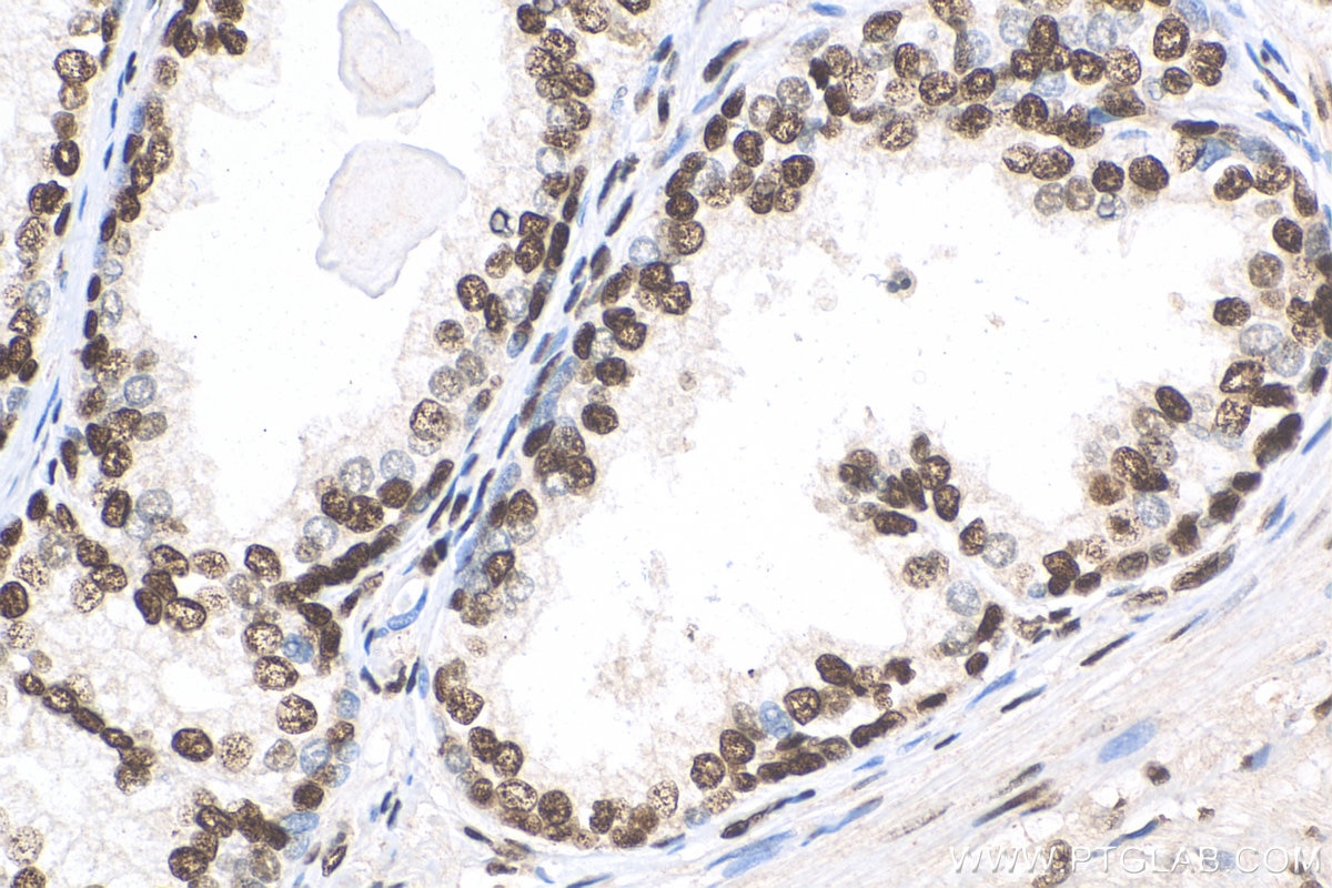 Immunohistochemistry (IHC) staining of human prostate cancer tissue using B23/NPM1 Recombinant antibody (82030-1-RR)
