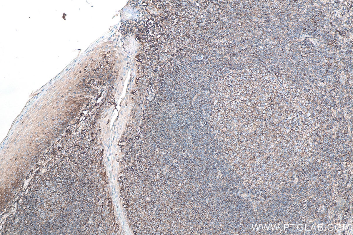 IHC staining of human tonsillitis using 13511-1-AP Immunohistochemistry (IHC) staining of human tonsillitis tissue using Beta-2-Microglobulin Polyclonal antibody (13511-1-AP)