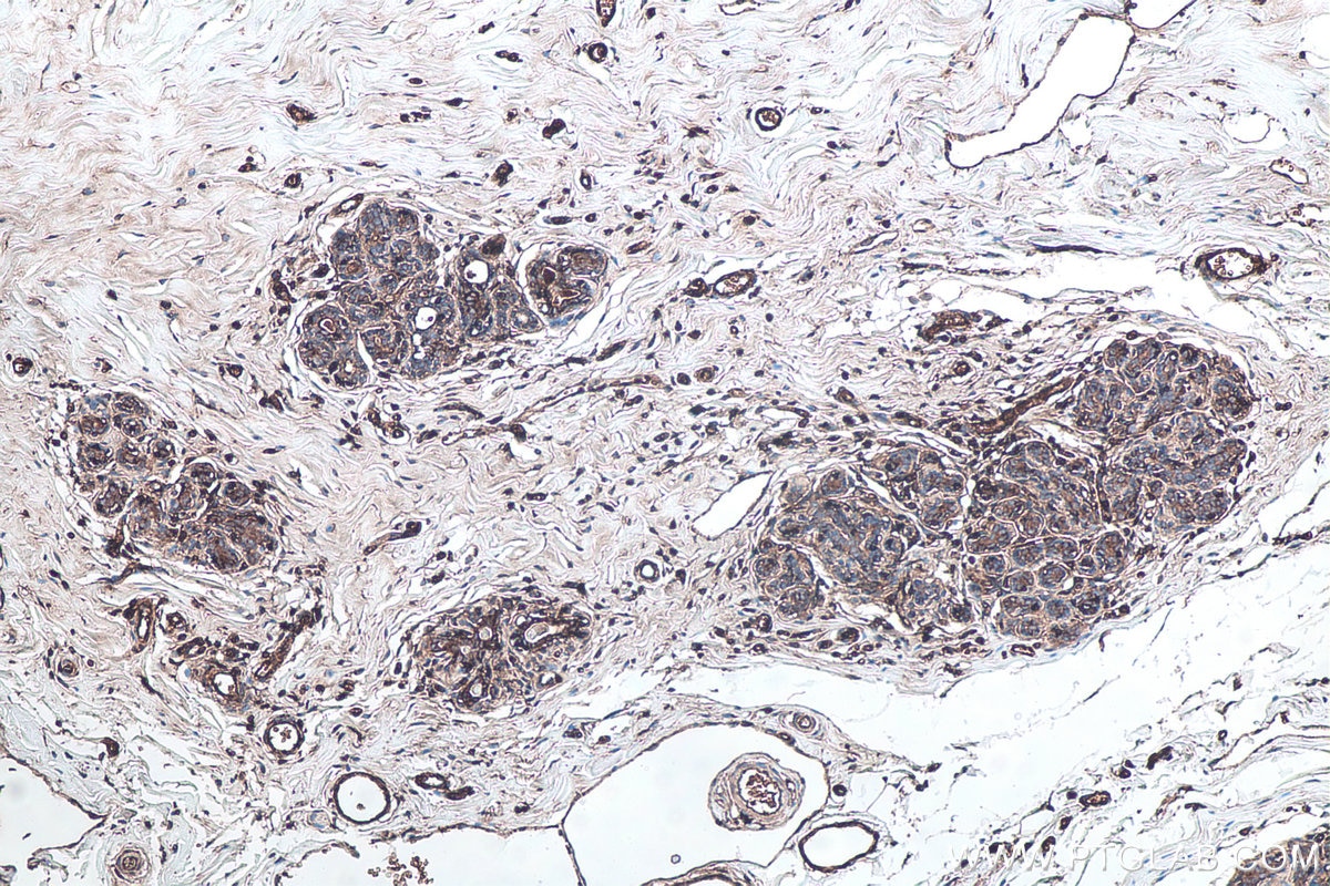 IHC staining of human breast cancer using 13511-1-AP Immunohistochemistry (IHC) staining of human breast cancer tissue using Beta-2-Microglobulin Polyclonal antibody (13511-1-AP)