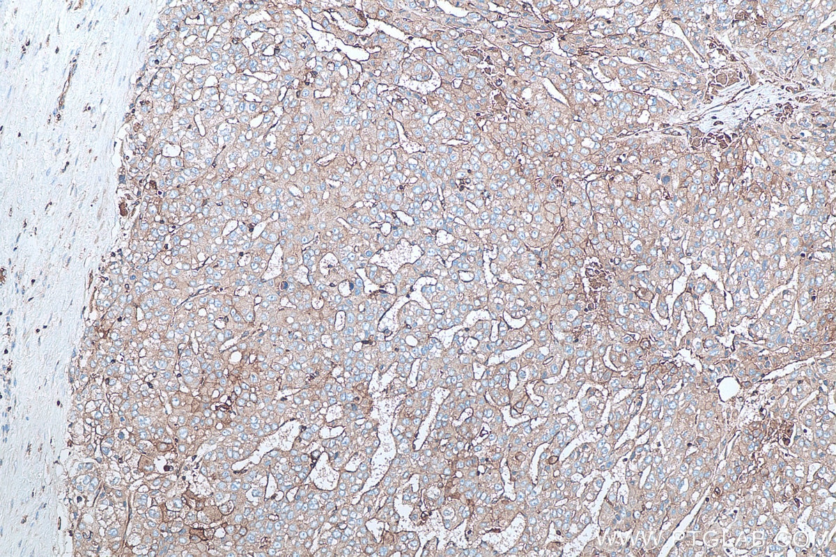 Immunohistochemistry (IHC) staining of human liver cancer tissue using Beta-2-Microglobulin Polyclonal antibody (13511-1-AP)