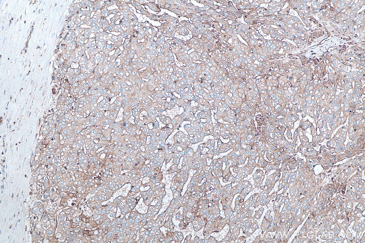 IHC staining of human liver cancer using 13511-1-AP