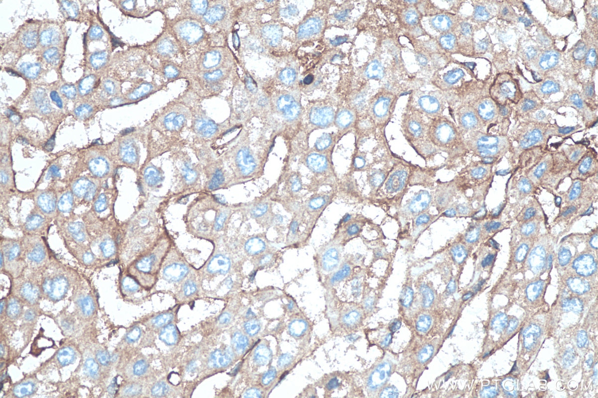 IHC staining of human liver cancer using 13511-1-AP