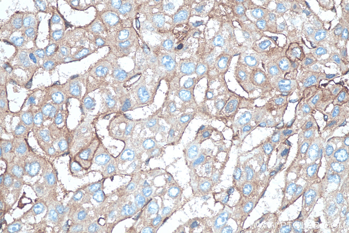 Immunohistochemistry (IHC) staining of human liver cancer tissue using Beta-2-Microglobulin Polyclonal antibody (13511-1-AP)