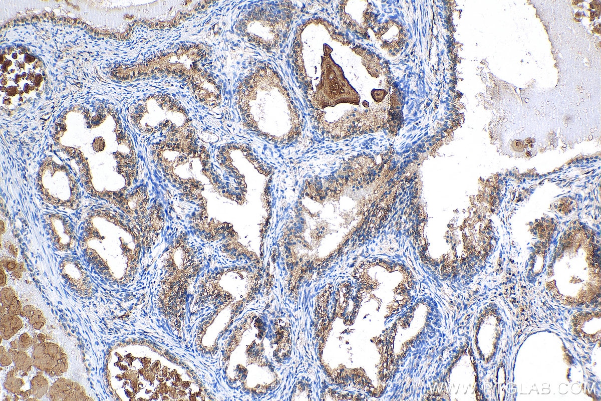 Immunohistochemistry (IHC) staining of human prostate cancer tissue using Beta-2-Microglobulin Polyclonal antibody (13511-1-AP)